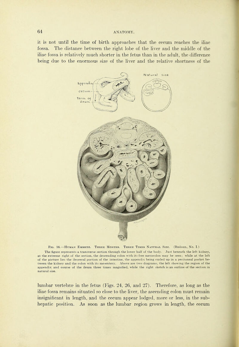 it is not until the time of birth approaches that the cecum reaches the iUac fossa. The distance between the right lobe of the liver and the middle of the iliac fossa is relatively much shorter in the fetus than in the adult, the difference being due to the enormous size of the liver and the relative shortness of the Fig. 16.—Human Embryo. Three Months. Three Times Natural Size. (Brodel, No. I.) The figure represents a transverse section through the lower half of the body. Just beneath the left kidney, at the extreme right of the section, the descending colon with its free mesocolon may be seen; while at the left of the picture lies the ileocecal portion of the intestine, the appendix being curled up in a peritoneal pocket be- tween the kidney and the colon with its mesentery. Above are two diagrams, the left showing the region of the appendix and course of the ileum three times magnified, while the right sketch is an outline of the section in natural size. lumbar vertebrae in the fetus (Figs. 24, 26, and 27). Therefore, as long as the iliac fossa remains situated so close to the liver, the ascending colon must remain insignificant in length, and the cecum appear lodged, more or less, in the sub- hepatic position. As soon as the lumbar region grows in length, the cecum