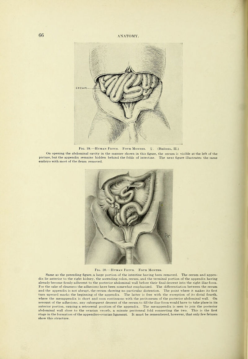 Fig. 19.—Human Fetus. Four Months. $. (Brodel, II.) On opening the abdominal cavity in the manner shown in this figure, the cecum is visible at the left of the picture, but the appendix remains hidden behind the folds of intestine. The next figure illustrates the same embryo with most of the ileum removed. Fig. 20.—Human Fetus. Four Months. Same as the preceding figure, a large portion of the intestine having been removed. The cecum and appen- dix lie anterior to the right kidney, the ascending colon, cecum, and the terminal portion of the appendix having already become firmly adherent to the po.sterior abdominal wall before their final descent into the right iliac fossa. For the sake of clearness the adhesions have been somewhat emphasized. The difTerentiation between the cecum and the appendix is not abrupt, the cecum showing no particular distention. The point where it makes its first turn upward marks the beginning of the appendix. The latter is free with the exception of its distal fourth, where the mesappendix is short and soon continuous with the peritoneum of the po.sterior abdominal wall. On account of the adhesions, any subsequent descent of the cecum to fill the iliac fos.sa would have to take place in its anterior portion, causing a retrocecal position of the appendix. The mesappendix is seen to join the posterior abdominal wall close to the ovarian vessels, a minute peritoneal fold connecting the two. This is the first stage in the formation of the appendico-ovarian ligament. It must be remembered, however, that only few fetuses show this structure.