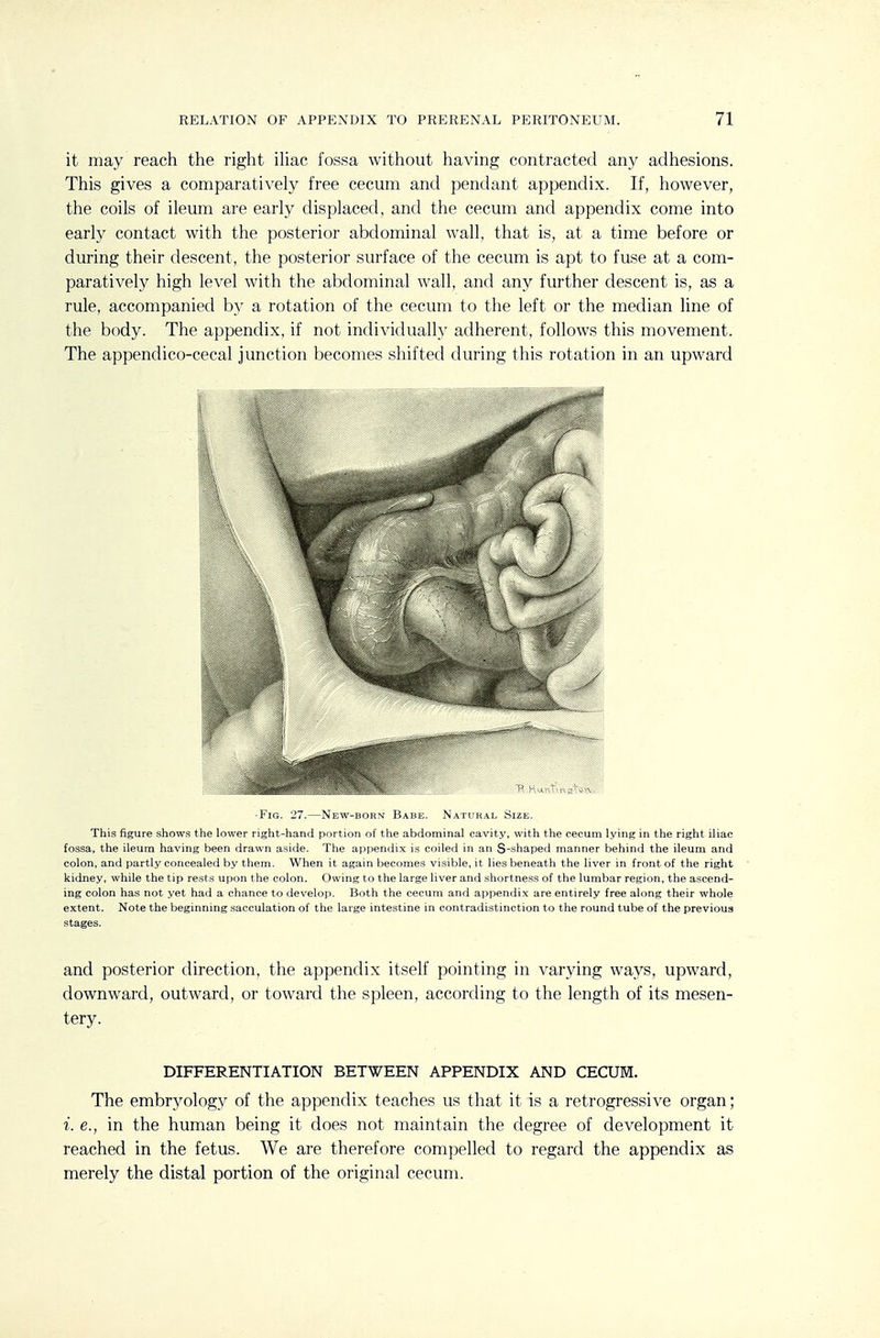 it may reach the right ihac fossa without having contracted any adhesions. This gives a comparatively free cecum and pendant appendix. If, however, the coils of ileum are early displaced, and the cecum and appendix come into early contact with the posterior abdominal wall, that is, at a time before or during their descent, the posterior surface of the cecum is apt to fuse at a com- paratively high level with the abdominal wall, and any further descent is, as a rule, accompanied by a rotation of the cecum to the left or the median line of the body. The appendix, if not individually adherent, follows this movement. The appendico-cecal junction becomes shifted during this rotation in an upward -Fig. 27.—New-born Babe. Natural Size. This figure shows the lower right-hand portion of the abdominal cavity, with the cecum lying in the right iliac fossa, the ileum having been drawn aside. The appendix is coiled in an S-shaped manner behind the ileum and colon, and partly concealed by them. When it again becomes visible, it lies beneath the liver in front of the right kidney, while the tip rests upon the colon. Owing to the large liver and shortness of the lumbar region, the ascend- ing colon has not yet had a chance to develop. Both the cecum and appendix are entirely free along their whole extent. Note the beginning sacculation of the large intestine in contradistinction to the round tube of the previous stages. and posterior direction, the appendix itself pointing in varying ways, upward, downward, outward, or toward the spleen, according to the length of its mesen- tery. DIFFERENTIATION BETWEEN APPENDIX AND CECUM. The embryology of the appendix teaches us that it is a retrogressive organ; i. e., in the human being it does not maintain the degree of development it reached in the fetus. We are therefore compelled to regard the appendix as merely the distal portion of the original cecum.