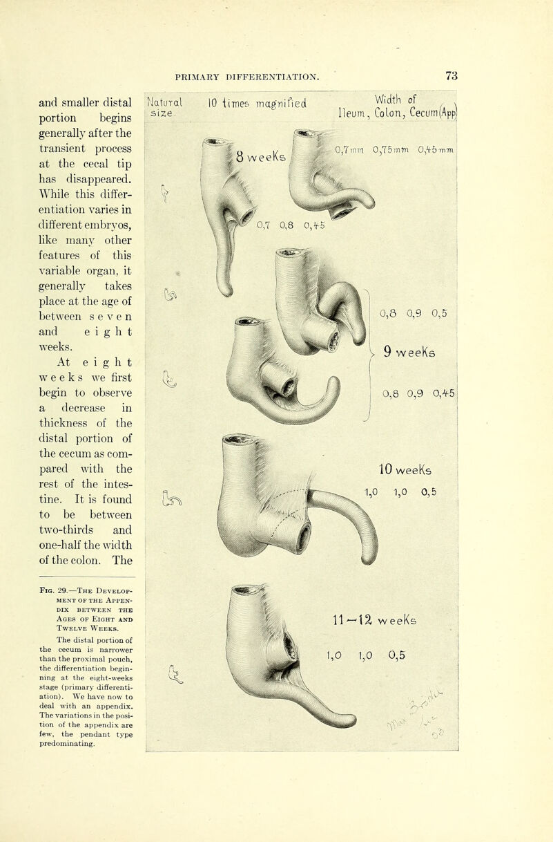 Fig. 29.—The Develop- ment of the Appen- dix BETWEEN THE Ages of Eight and Twelve Weeks. The distal portion of the cecum is narrower than the proximal pouch, the differentiation begin- ning at the eight-weeks stage (primary differenti- ation). We have now to deal with an appendix. The variations in the posi- tion of the appendix are few, the pendant type predominating. and smaller distal Natural portion begins ^'^^ generall)^ after the transient process at the cecal tip has disappeared. While this differ- entiation varies in different embryos, like many other features of this variable organ, it generally takes place at the age of between seven and eight weeks. At eight weeks we first begin to observe a decrease in thickness of the distal portion of the cecum as com- pared with the rest of the intes- tine. It is found to be between two-thirds and one-half the width of the colon. The 10 iimes magnified Width of Ileum, Colon, CecL(rn(Appl 0,7inin 0,75i7i7n O.H-b-mm.