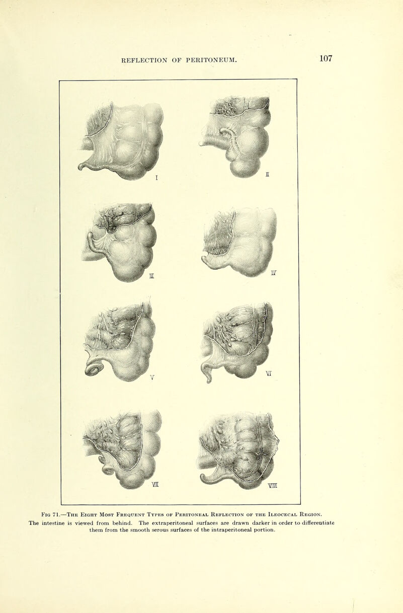 REFLECTION OF PERITONEUM. Fig 71.—The Eight Most Frequent Types of Peritoneal Reflection of the Ileocecal Region. The intestine is viewed from behind. Tiie extraperitoneal surfaces are drawn daricer in order to differentiate them from the smooth serous surfaces of the intraperitoneal portion.