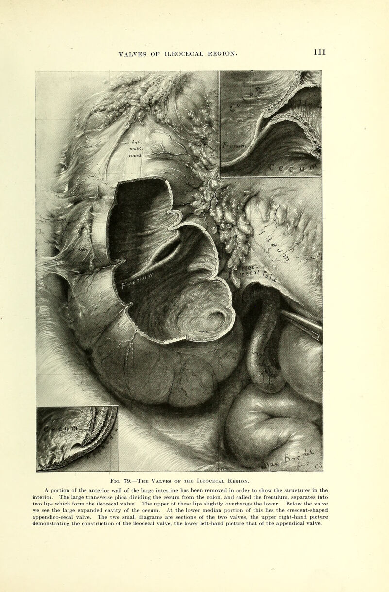 VALVES OF ILEOCECAL REGION. Fig. 79.—The Valves of the Ileocecal Kegion. A portion of the anterior wall of the large intestine has been removed in order to show the structures in the interior. The large transverse plica dividing the cecum from the colon, and called the frenulum, separates into two lips which form the ileocecal valve. The upper of the.se lips .slightly overhangs the lower. Below the valve we .see the large expanded cavity of the cecum. At the lower median portion of this lies the crescent-shaped appendico-cecal valve. The two small diagrams are sections of the two valves, the upper right-hand picture demonstrating the construction of the ileocecal valve, the lower left-hand picture that of the appendical valve.