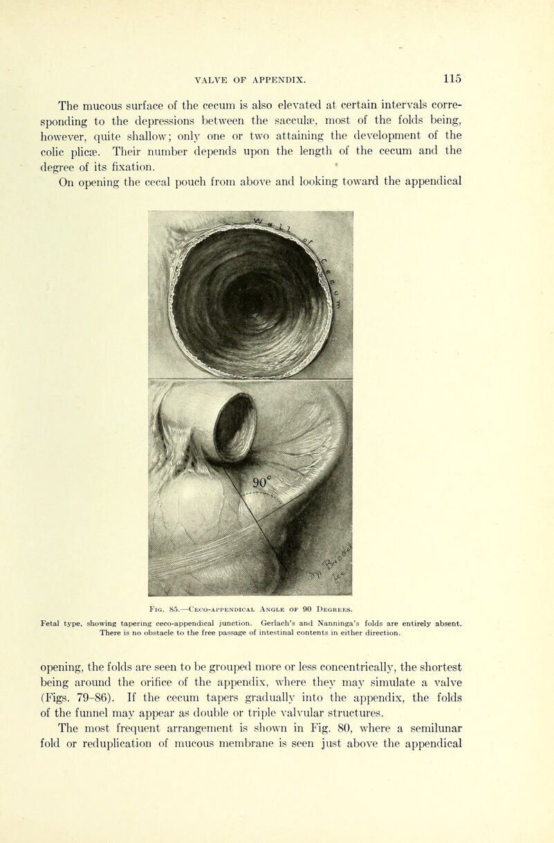 The mucous surface of the cecum is also elevated at certain intervals corre- sponding to the depressions between the sacculse, most of the folds being, however, quite shallow; only one or two attaining the development of the colic plicre. Their number depends upon the length of the cecum and the degree of its fixation. On opening the cecal pouch from above and looking toward the appendical Fig. 8.5.—Ceco-ai'i'kndical Angle of 90 Degrees. Fetal type, showing tapering ceco-appendical junction. Gerlach's and Nanninga's folds are entirely absent. There is no obstacle to the free passage of inte.stinal contents in either direction. opening, the folds are seen to be grouped more or less concentricallj^, the shortest being around the orifice of the appendix, where they may simulate a valve (Figs. 79-86). If the cecum tapers gradually into the appendix, the folds of the funnel may appear as double or triple A'alvular structures. The most frequent arrangement is shown in Fig. 80, where a semilunar fold or reduplication of mucous membrane is seen just above the appendical