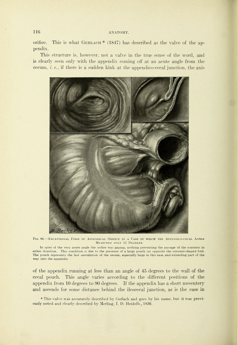 orifice. This is what Gerlach * (1847) has described as the valve of the ap- pendix. This structure is, however, not a valve in the true sense of the word, and is clearly seen only with the appendix coming off at an acute angle from the cecum, {. e., if there is a sudden kink at the appendico-ceeal junction, the axis Fig. 86.—Exceptional Fokm of Appendical Orifice in a Case in which the Appendico-cecal .\.ngle Measured only 12 Degrees. In spite of the very acute angle the orifice was gaping, nothing preventing the passage of the contents in either direction. This condition is due to the presence of a large pouch (a) opposite the crescent-shaped fold. The pouch represents the last sacculation of the cecum, especially large in this case, and extending part of the way into the appendix. of the appendix running at less than an angle of 45 degrees to the wall of the cecal pouch. This angle varies according to the different positions of the appendix from 10 degrees to 90 degrees. If the appendix has a short mesentery and ascends for some distance behind the ileocecal junction, as is the case in * This valve was accurately described by Gerlach and goes by his name, but it was previ- ously noted and clearly described by Merling, I. D. Heidelb., 1836.