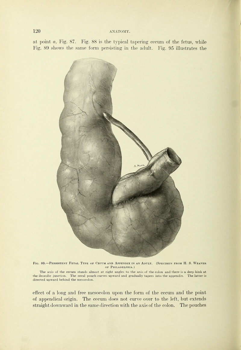 at point a, Fig. 87. Fig. 88 is the typical tapering cecum of the fetus, while Fig. 89 shows the same form persisting in the adult. Fig. 95 illustrates the Fig. 89.—Persistent Fetal Type of Cecum and Appendix in an Adult. (Specimen from H. S. Weaver OF Philadelphia.) The axis of the cecum stands almost at risht angles to the axis of the colon and there is a deep kink at the ileocolic junction. The cecal pouch curves upward and gradually tapers into the appendix. The latter is directed upward behind the mesocolon. effect of a long and free mesocolon upon the form of the cecum and the point of appendical origin. The cecum does not curve over to the left, but extends straight downward in the same direction with the axis of the colon. The pouches