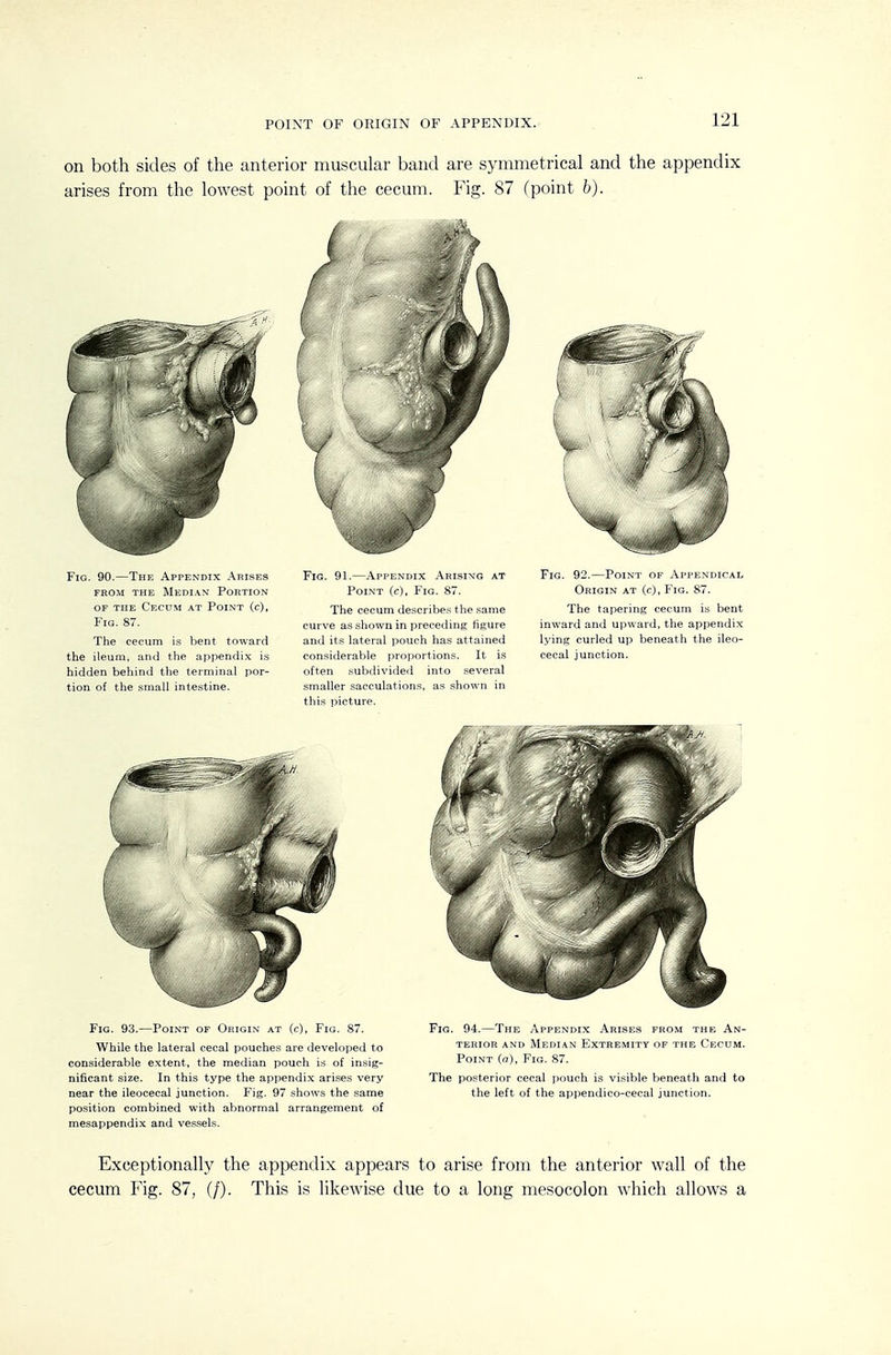 on both sides of the anterior muscular band are symmetrical and the appendix arises from the lowest point of the cecum. Fig. 87 (point b). Fig. 90.—The Appendix Arises FROM THE MeDI.\N PORTION OF THE Cecum at Point (c). Fig. 87. The cecum is bent toward the ileum, and the appendix is hidden behind the terminal por- tion of the small intestine. Fig. 91.—Appendix Arising at Point (c), Fig. 87. The cecum describes the same curve as shown in preceding figure and its lateral pouch has attained considerable proportions. It is often subdivided into several smaller sacculations, as shown in this picture. Fig. 92.—Point of Appendical Origin at (c), Fig. 87. The tapering cecum is bent inward and upward, the appendix lying curled up beneath the ileo- cecal junction. Fig. 93.—Point of Origin at (c). Fig. 87. While the lateral cecal pouches are developed to considerable extent, the median pouch is of insig- nificant size. In this type the appendix arises very near the ileocecal junction. Fig. 97 shows the same position combined with abnormal arrangement of mesappendix and vessels. Fig. 94.—The Appendix Arises from the An- terior AND Median Extremity of the Cecum. Point (a). Fig. 87. The posterior cecal pouch is visible beneath and to the left of the appendico-cecal junction. Exceptionally the appendix appears to arise from the anterior wall of the cecum Fig. 87, (/). This is likewise due to a long mesocolon which allows a