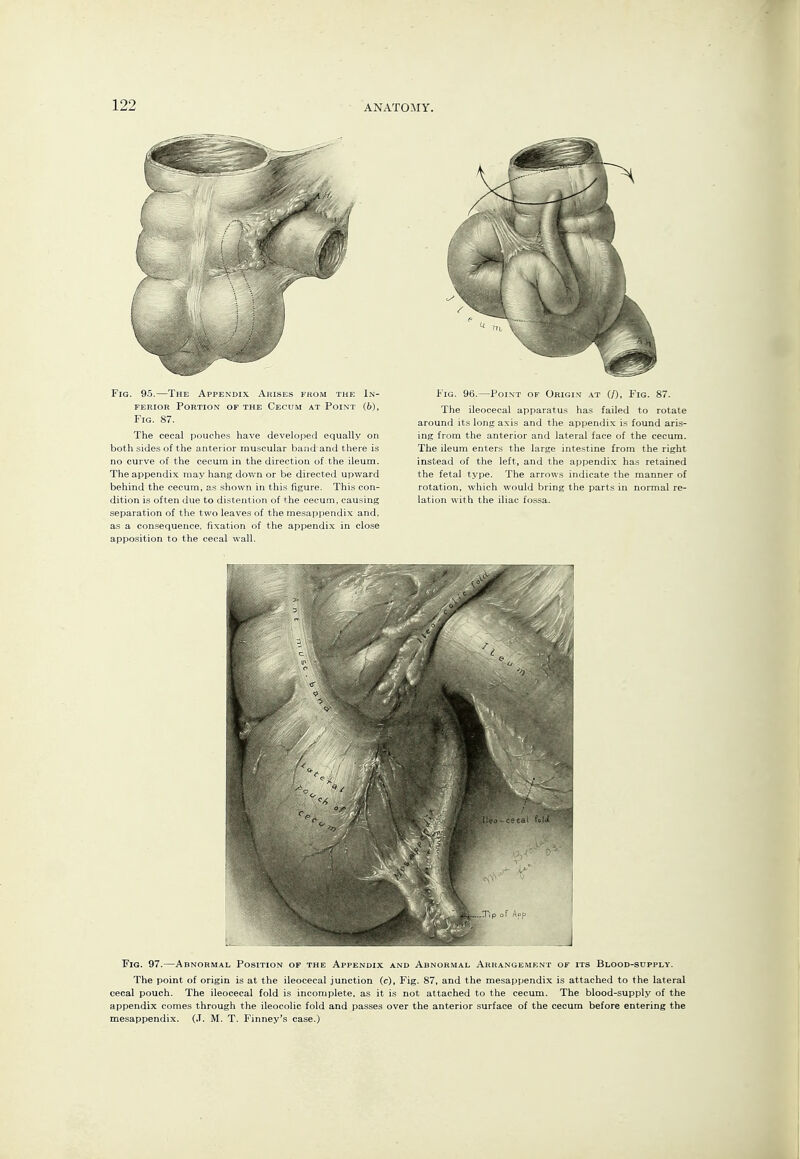 Fig. 95.—The Appendix Arises from the Xn- FEKiOR Portion of the Cecum at Point (b), Fig. 87. The cecal pouches have developed equally on both sides of the anterior muscular band and there is no curve of the cecum in the direction of the ileum. The appendix may hang dov/n or be directed upward behind the cecum, as shown in this figure. This con- dition is often due to distention of the cecum, causing separation of the two leaves of the mesappendix and, as a consequence, fixation of the appendix in close apposition to the cecal wall. Fig. 96.—Point of Origin at (/), Fig. 87. The ileocecal apparatus has failed to rotate around its long axis and the appendix is found aris- ing from the anterior and lateral face of the cecum. The ileum enters the large intestine from the right instead of the left, and the appendix has retained the fetal type. The arrows indicate the manner of rotation, which would bring the parts in normal re- lation with the iliac fossa. Fig. 97.—Abnormal Position of the Appendix and Abnormal Arrangement of its Blood-supply. The point of origin is at the ileocecal junction (c), Fig. 87, and the mesappendix is attached to the lateral cecal pouch. The ileocecal fold is incomplete, as it is not attached to the cecum. The blood-supply of the appendix comes through the ileocolic fold and passes over the anterior surface of the cecum before entering the mesappendix. (.T. M. T. Finney's case.)