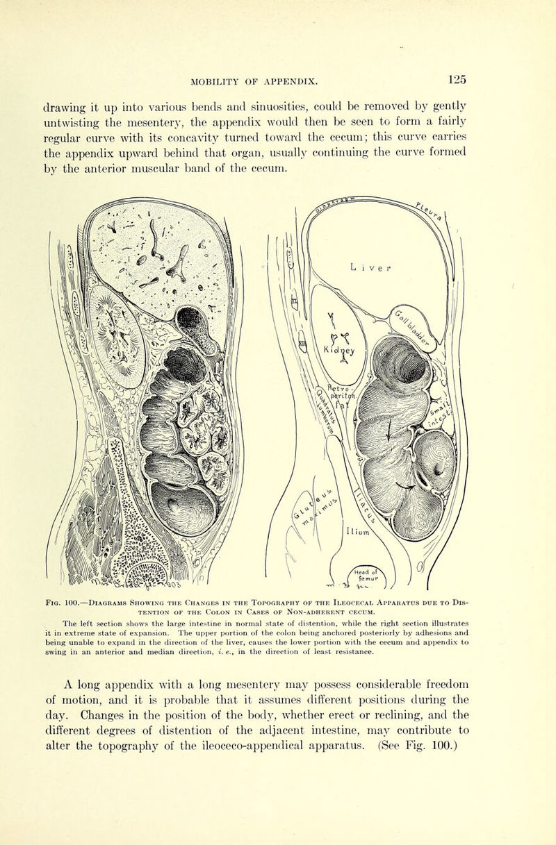 MOBILITY OF APPENDIX. drawing it up into various bends and sinuosities, could be removed by gently untwisting the mesentery, the appendix would then be seen to form a fairly regular curve with its concavity turned toward the cecum; this curve carries the appendix upward behind that organ, usually continuing the curve formed by the anterior muscular band of the cecum. Fig. 100.—Diagrams Showing the Changes in the Topography of the Ileocecal Apparatus due to Dis- tention OF the Colon in Cases of Non-adherent cecum. The left section shows the large intestine in normal state of distention, while the right section illustrates it in extreme state of expansion. The upper portion of the colon being anchored posteriorly by adhesions and being unable to expand in the direction of the liver, causes the lower portion with the cecum and appendix to swing in an anterior and median direction, i. e., in the direction of least resistance. A long appendix with a long mesentery may possess considerable freedom of motion, and it is probable that it assumes different positions during the day. Changes in the position of the body, Avhether erect or reclining, and the different degrees of distention of the adjacent intestine, may contribute to alter the topography of the ileoceco-appentlical apparatus. (See Fig. 100.)