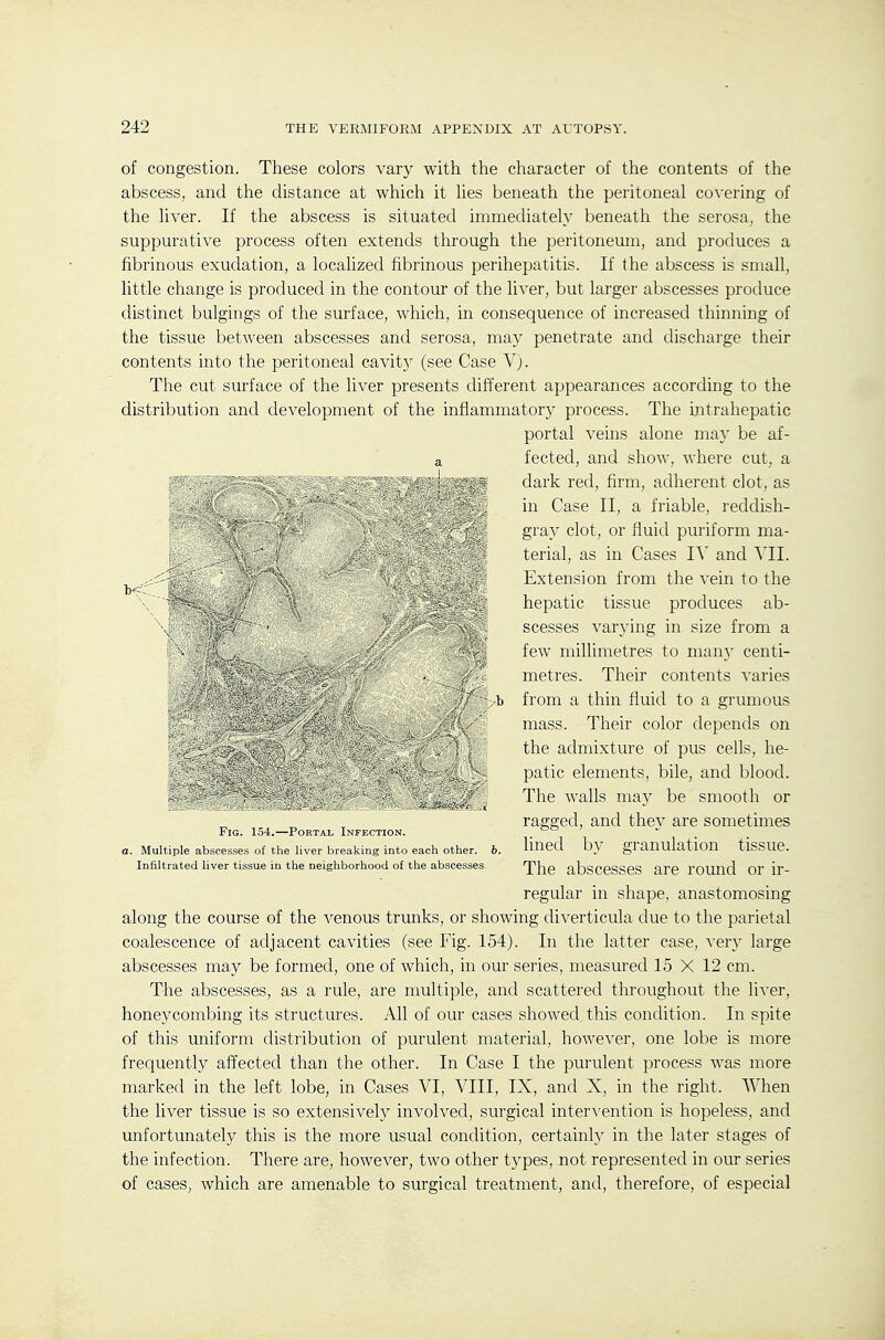 of congestion. These colors vary with the character of the contents of the abscess, and the distance at which it Ues beneath the peritoneal covering of the liver. If the abscess is situated immediately beneath the serosa, the suppurative process often extends through the peritoneum, and produces a fibrinous exudation, a localized fibrinous perihepatitis. If the abscess is small, little change is produced in the contour of the liver, but larger abscesses produce distinct bulgings of the surface, which, in consequence of increased thinning of the tissue between abscesses and serosa, may penetrate and discharge their contents into the peritoneal cavitj' (see Case V). The cut surface of the lii^er presents different appearances according to the distribution and development of the inflammatory process. The intrahepatic along the course of the venous trunks, or showing diverticula due to the parietal coalescence of adjacent cavities (see Fig. 154). In the latter case, very large abscesses may be formed, one of which, in our series, measured 15 X 12 cm. The abscesses, as a rule, are multiple, and scattered throughout the Yixer, honeycombing its structures. All of our cases showed this condition. In spite of this uniform distribution of purulent material, however, one lobe is more frequently affected than the other. In Case I the purulent })rocess was more marked in the left lobe, in Cases VI, VIII, IX, and X, in the right. When the liver tissue is so extensively involved, surgical inter-\-ention is hopeless, and unfortunately this is the more usual condition, certainly in the later stages of the infection. There are, however, two other types, not represented in our series of cases, which are amenable to surgical treatment, and, therefore, of especial Fig. 154.—Portal Infection. a. Multiple abscesses of the liver breaking into each other. 6. Infiltrated liver tissue in the neighborhood of the abscesses. \ a - portal veins alone may be af- fected, and show, where cut, a dark red, firm, adherent clot, as in Case II, a friable, reddish- gray clot, or fluid puriform ma- terial, as in Cases IV and Extension from the vein to the hepatic tissue produces ab- scesses varying in size from a few millimetres to many centi- metres. Their contents varies from a thin fluid to a grumous mass. Their color depends on the admixture of pus cells, he- patic elements, bile, and blood. The walls ma}' be smooth or ragged, and they are sometmies lined by granulation tissue. The abscesses are round or ir- regular in shape, anastomosing