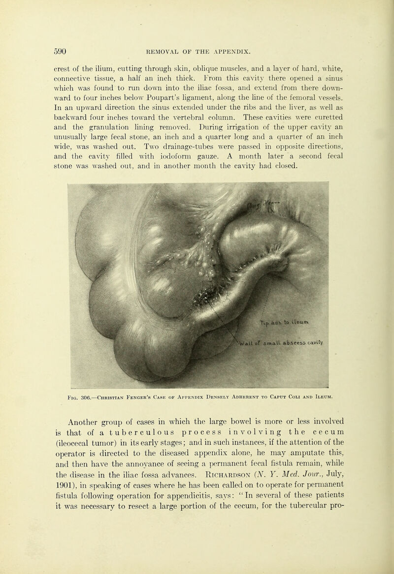 crest of the ilium, cutting through skin, obhque muscles, and a layer of hard, white, connective tissue, a half an inch thick. From this cavity there opened a sinus which was found to run down into the ihac fossa, and extend from there do-mi- ward to four inches below Poupart's ligament, along the line of the femoral vessels. In an upward direction the sinus extended under the ribs and the lixev, as well as backward four inches toward the vertebral column. These cavities were curetted and the granulation lining removed. During irrigation of the upper ca^■ity an unusually large fecal stone, an inch and a quarter long and a quarter of an inch wide, was washed out. Two drainage-tubes were passed in opposite directions, and the cavity filled with iodoform gauze. A month later a second fecal stone was w^ashed out, and in another month the cavity had closed. Fig. 306.—^Christian Fencer's Case of Appendix Densely Adherent to Caput Com and Ileum. Another group of cases in which the large bowel is more or less involved is that of a tuberculous process involving the cecum (ileocecal tumor) in its early stages; and in such instances, if the attention of the operator is directed to the diseased appendix alone, he may amputate this, and then have the annoyance of seeing a permanent fecal fistula remain, while the disease in the iliac fossa advances. Richardson (N. Y. Med. Jour., July, 1901), in speaking of cases where he has been called on to operate for permanent fistula following operation for appendicitis, says: In several of these patients it was necessary to resect a large portion of the cecum, for the tubercular pro-