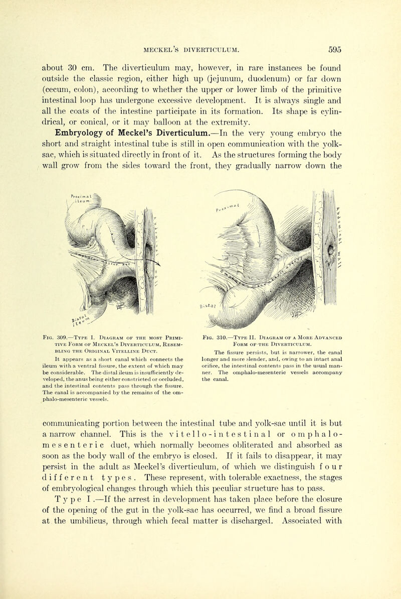 about 30 cm. The diverticulum may, however, in rare instances be found outside the classic region, either high up (jejunum, duodenum) or far down (cecum, colon), according to whether the upper or lower limb of the primitive intestinal loop has undergone excessive development. It is always single and all the coats of the intestine participate in its formation. Its shape is cylin- drical, or conical, or it may balloon at the extremity. Embryology of Meckel's Diverticulum.—In the very young embryo the short and straight intestinal tube is still in open communication with the yolk- sac, which is situated directly in front of it. As the structures forming the body wall grow from the sides toward the front, they gradually narrow down the Fig. 309.—Type I. Diagram of the most Primi- tive Form of Meckel's Diverticulum, Resem- bling THE Original Vitelline Duct. It appears as a short canal which connects the ileum with a ventral fissure, the extent of which may be considerable. The di.stal ileum is insufficiently de- veloped, the anus being either con.strieted or occluded, and the intestinal contents pa.ss through the fi.ssure. The canal is accompanied by the remains of the om- phalo-mesenteric vessels. Fig. 310.—Type II. Diagram of a More Advanced Form of^he Diverticulum. The fissure persists, but is narrower, the canal longer and more .slender, and, owing to an intact anal orifice, the intestinal contents pass in the usual man- ner. The omphalo-mesenteric vessels accompany the canal. communicating portion between the intestinal tube and yolk-sac until it is but a narrow channel. This is the v i t e 11 o - i n t e s t i n a 1 or omphalo- mesenteric duct, which normally becomes obliterated and absorbed as soon as the body wall of the embryo is closed. If it fails to disappear, it may persist in the adult as Meckel's diverticulum, of which we distinguish four different types. These represent, with tolerable exactness, the stages of embryological changes through which this peculiar structure has to pass. Type I.—If the arrest in development has taken place before the closure of the opening of the gut in the yolk-sac has occurred, we find a broad fissure at the umbilicus, through which fecal matter is discharged. Associated with