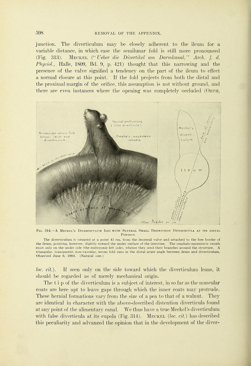 junction. The diverticulum may be closely adherent to the ileum for a variable distance, in which case the semilunar fold is still more pronounced (Fig. 313). Meckel ( Ueber die Divertikel am Darmkanal, Arch. /. d. Physiol., Halle, 1809, Bd. 9, p. 421) thought that this narrowing and the presence of the valve signified a tendency on the part of the ileum to effect a normal closure at this point. If the fold projects from both the distal and the proximal margin of the orifice, this assumption is not without ground, and there are even instances where the opening was completely occluded (Orth, Fig. 314.—A Meckel's Diverticulum Ilei with Several Small Distention Diverticula at its distal Portion. The diverticulum is situated at a point 45 cm. from the ileocecal valve and attached to the free border of the ileum, pointing, however, slightly toward the under surface of the intestine. The omphalo-mesenteric vessels exist only on the under side (the embryonic left side), whence they send their branches around the structure. A triangular, transparent, non-vascular, serous fold runs in the distal acute angle between ileum and diverticulum. Observed June 6, 1904. (Natural size.) loc. cit.). If seen only on the side toward which the diverticulum leans, it should be regarded as of merely mechanical origin. The t i p of the diverticulum is a subject of interest, in so far as the muscular coats are here apt to leave gaps through which the inner coats may protrude. These hernial formations vary from the size of a pea to that of a walnut. They are identical in character with the above-described distention diverticula found at any point of the alimentary canal. We thus have a true Meckel's di-\'erticulum with false diverticula at its cupola (Fig. 314). Meckel {loc. cit.) has described this peculiarity and advanced the opinion that in the development of the diver-