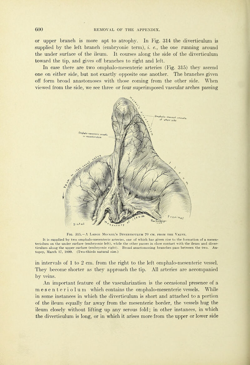 or upper branch is more apt to atrophy. In Fig. 314 the diverticulum is supphed by the left branch (embryonic term), i. e., the one running around the under surface of the ileum. It courses along the side of the diverticulum toward the tip, and gives off branches to right and left. In case there are two omphalo-mesenteric arteries (Fig. 315) they ascend one on either side, but not exactly opposite one another. The branches given off form broad anastomoses with those coming from the other side. When viewed from the side, we see three or four superimposed vascular arches passing Fig. 315.—A Large Meckel's Diverticulum 70 cm. from the Valve. It is supplied by two omphalo-mesenteric arteries, one of which has given rise to the formation of a mesen- teriolum on the under surface (embryonic left), while the other passes in close contact with the ileum and diver- ticulum along the upper surface (embryonic right). Broad anastomosing branches pass between the two. Au- topsy, March 17, 1899. (Two-thirds natural size.) in intervals of 1 to 2 cm. from the right to the left omphalo-mesenteric vessel. They become shorter as they approach the tip. All arteries are accompanied hy veins. An important feature of the vascularization is the occasional presence of a mesenteriolum which contains the omphalo-mesenteric vessels. While in some instances in which the diverticulum is short and attached to a portion of the ileum equally far away from the mesenteric border, the vessels hug the ileum closely without lifting up any serous fold; in other instances, in which the diverticulum is long, or in which it arises more from the upper or lower side