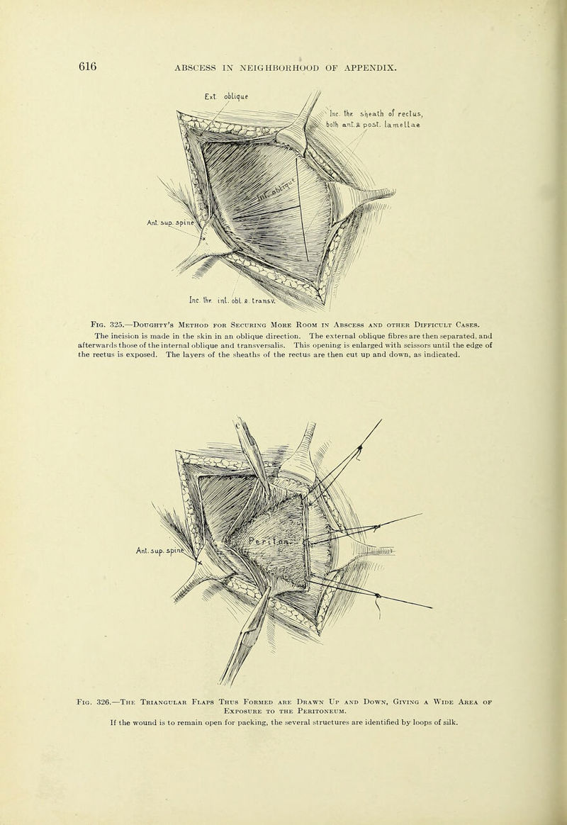 5 Fig. 326.—The Triangular Flaps Thus Formed are Drawn Up and Down, Giving a Wide Area of Exposure to the Peritoneum. If the wound is to remain open for packing, the several structures are identified by loops of silk.