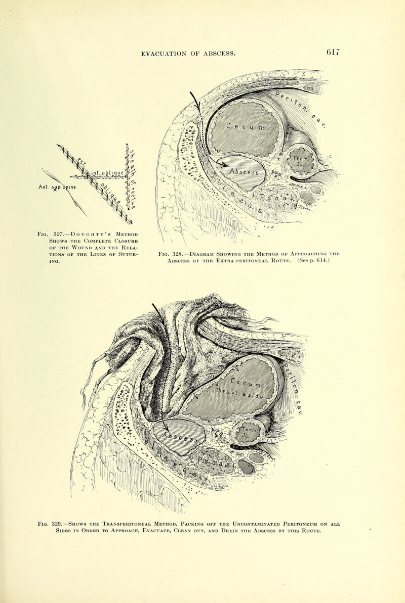 Fig. 329.—Shows the Transperitoneal Method, Packing off the Uncontaminated Peritonetjm on all Sides in Order to Approach, Evacuate, Clean o0t, and Drain the Abscess by this Route.