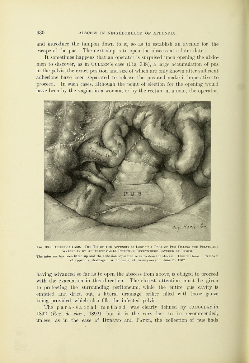 and introduce the tampon down to it, so as to establish an avenue for the escape of the pus. The next step is to open the abscess at a later date. It sometimes happens that an operator is sui'prised upon opening the abdo- men to discover, as in Cullen's case (Fig. 338), a large accumulation of pus in the pelvis, the exact position and size of which are only known after sufficient adhesions have been separated to release the pus and make it imperati\e to proceed. In such cases, although the point of election for the opening would have been by the vagina in a woman, or by the rectum in a man, the operator, Fig. 338.—Cullen's Case. The Tip of the Api-exdix is Lost in a Pool of Pus I'illing the Pelvis and Walled in by Adherent Small Intestine Everywhere Covered by Ly'mph. The intestine has been lifted up and the adhesion separated so as to show the abscess. Church Home. Removal of appendix, drainage. W. P., male, ait. twenty-seven. June 26, 1902. having advanced so far as to open the abscess from above, is obliged to proceed with the evacuation in this direction. The closest attention must be given to protecting the surrounding peritoneum, while the entire pus cavitj' is emptied and dried out, a liberal drainage orifice filled with loose gauze being provided, which also fills the infected pelvis. The para-sacral method was clearl)^ defined b}^ Jaboulay in 1892 (Rev. de chir., 1892), but it is the very last to be recommended, unless, as in the case of Berard and Patel, the collection of pus finds