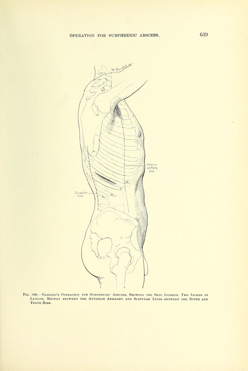 Fig. 340.—Elsbehg's Operation for Subphrenic Abscess, Showing the Skin Incision, Two Inches in Length, Midway between the Anterior Axillary and Scapular Lines between the Ninth and Tenth Ribs.