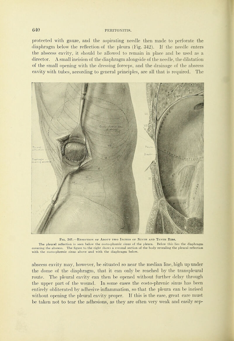 protected with gauze, and the aspirating needle then made to perforate the diaphragm below the reflection of the plem-a (Fig. 342). If the needle enters the abscess cavity, it should be allowed to remain in place and be used as a director. A small incision of the diaphragm alongside of the needle, the dilatation of the small opening with the dressing forceps, and the drainage of the abscess cavity with tubes, according to general principles, are all that is required. The Fig. 341.—Resection of About two Inches of Ninth and Tenth Ribs. The pleural reflection is seen below the costo-phrenic sinus of the pleura. Below this lies the diaphragm covering the abscess. The figure to the right shows a coronal section of the body revealing the pleural reflection with the costo-phrenic sinus above and with the diaphragm below. abscess cavity may, however, be situated so near the median line, high upimder the dome of the diaphragm, that it can only be reached b} the transpleural route. The pleural cavity can then be opened without further delay through the upper part of the wound. In some cases the costo-phrenic sinus has been entirely obliterated by adhesive inflammation, so that the pleura can be incised without opening the pleural cavit}^ proper. If this is the case, great care must be taken not to tear the adhesions, as they are often very weak and easily sep-