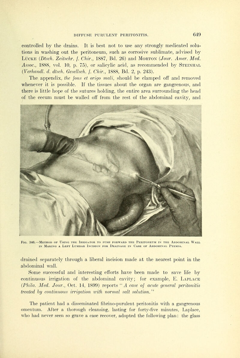 controlled by the drains. It is best not to use any strongly medicated solu- tions in washing out the peritoneum, such as corrosive sublimate, advised by LiicKE (Dtsch. Zeitschr. f. Chir., 1887, Bd. 26) and Morton (Jour. Amer. Med. Assoc., 1888, vol. 10, p. 75), or salicylic acid, as recommended by Steinhal (Verhandl. d. dtsch. Gesellsch. f. Chir., 1888, Bd. 2, p. 243). The appendix, the jons et origo malt, should be clamped off and removed whenever it is possible. If the tissues about the organ are gangrenous, and there is little hope of the sutures holding, the entire area surrounding the head of the cecum must be walled off from the rest of the abdominal cavity, and Fig. 346.—Method of Using the Irrigator to push forward the Peritoneum in the Abdominal Wall IN Making a Left Lumbar Incision for Drainage in Case of Abdominal Pyemia. drained separately through a liberal incision made at the nearest point in the abdominal wall. Some successful and interesting efforts have been made to save life by continuous irrigation of the abdominal cavity; for example, E. IjAPlace (Phila. Med. Jour., Oct. 14, 1899) reports A case of acute general peritonitis treated by continuous irrigation with normcd salt solution. The patient had a disseminated fibrino-punilent peritonitis with a gangrenous omentum. After a thorough cleansing, lasting for forty-five minutes, Laplace, who had never seen so grave a case recover, adopted the following plan: the glass