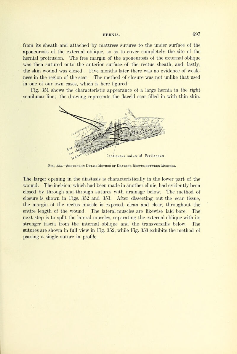 from its sheath and attached by mattress sutures to the under surface of the aponeurosis of the external obhque, so as to cover completely the site of the hernial protrusion. The free margin of the aponeurosis of the external oblique was then sutured onto the anterior surface of the rectus sheath, and, lastly, the skin wound was closed. Five months later there was no evidence of weak- ness in the region of the scar. The method of closure was not unlike that used in one of our own cases, which is here figured. Fig. 351 shows the characteristic appearance of a large hernia in the right semilunar line; the drawing represents the flaccid scar filled in with thin skin. Fig. 353.—Showing in Detail Method of Drawing Rectus between Muscles. The larger opening in the diastasis is characteristically in the lower part of the wound. The incision, which had been made in another clinic, had evidently been closed by through-and-through sutures with drainage below. The method of closure is shown in Figs. 352 and 353. After dissecting out the scar tissue, the margin of the rectus muscle is exposed, clean and clear, throughout the entire length of the wound. The lateral muscles are likewise laid bare. The next step is to split the lateral muscles, separating the external oblique with its stronger fascia from the internal oblique and the transversalis below. The sutures are shown in full view in Fig. 352, while Fig. 353 exhibits the method of passing a single suture in profile.