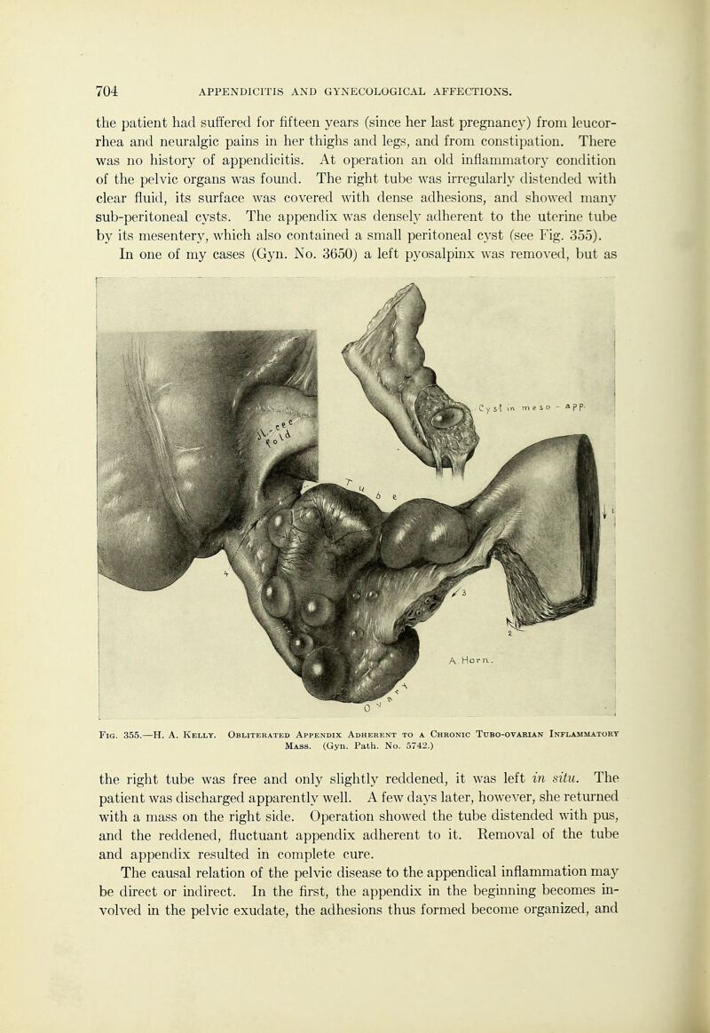 the patient had suffered for fifteen years (since her last pregnancy) from leucor- rhea and neuralgic pains in her thighs and legs, and from constipation. There was no history of appendicitis. At operation an old inflammatory condition of the pelvic organs was found. The right tube was irregularly distended with clear fluid, its surface was covered with dense adhesions, and showed manj^ sub-peritoneal cysts. The appendix was densely adherent to the uterine tube by its mesentery, which also contained a small peritoneal cyst (see Fig. 355). In one of my cases (Gyn. No. 3650) a left pyosalpinx was removed, but as i Fig. 355.—H. A. Kelly. Obliterated Appendix Adherent to a Chronic Tubo-ovarian Inflammatory Mass. (Gyn. Path. No. 5742.) the right tube was free and only slightly reddened, it was left i7i situ. The patient was discharged apparently well. A few days later, however, she returned with a mass on the right side. Operation showed the tube distended with pus, and the reddened, fluctuant appendix adherent to it. Removal of the tube and appendix resulted in complete cure. The causal relation of the pelvic disease to the appendical inflammation may be direct or indirect. In the first, the appendix in the beginning becomes in- volved in the pelvic exudate, the adhesions thus formed become organized, and