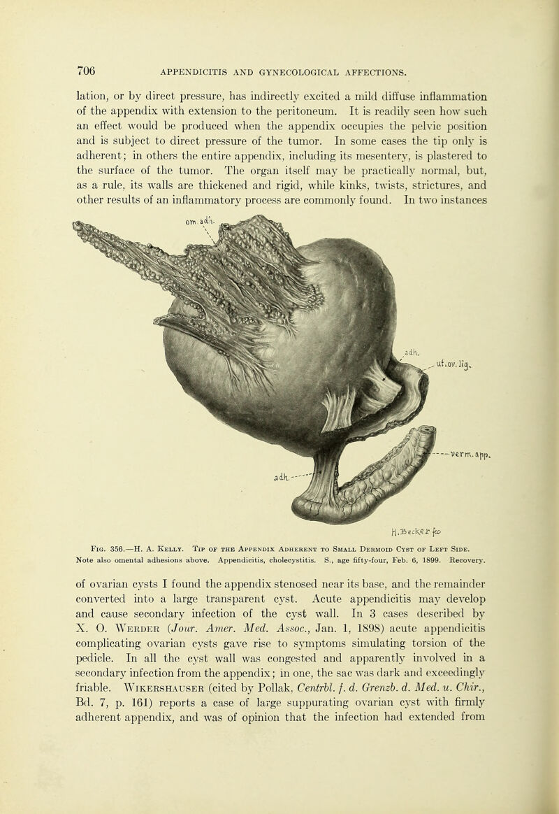 lation, or by direct pressure, has indirectly excited a mild diffuse inflammation of the appendix with extension to the peritoneum. It is readily seen how such an effect would be produced when the appendix occupies the pelvic position and is subject to direct pressure of the tumor. In some cases the tip only is adherent; in others the entire appendix, including its mesentery, is plastered to the surface of the tumor. The organ itself may be practically normal, but, as a rule, its walls are thickened and rigid, while kinks, twists, strictures, and other results of an inflammatory process are commonly found. In two instances Fig. 356.—H. A. Kelly. Tip of the Appendix Adherent to Small Dermoid Cyst of Left Side. Note also omental adhesions above. Appendicitis, cholecystitis. S., age fifty-four, Feb. 6, 1899. Recovery. of ovarian cysts I found the appendix stenosed near its base, and the remainder converted into a large transparent cyst. Acute appendicitis may develop and cause secondary infection of the cyst wall. In 3 cases described by X. 0. Werder {Jour. Amer. Med. Assoc., Jan. 1, 1898) acute appendicitis complicating ovarian cysts gave rise to symptoms simulating torsion of the pedicle. In all the C3^st wall was congested and apparentl}^ involved in a secondary infection from the appendix; in one, the sac was dark and exceedingly friable. Wikershauser (cited by Pollak, Centrbl. /. d. Grenzb. d. Med. u. Chir., Bd. 7, p. 161) reports a case of large suppurating ovarian cj'st with firmly adherent appendix, and was of opinion that the infection had extended from