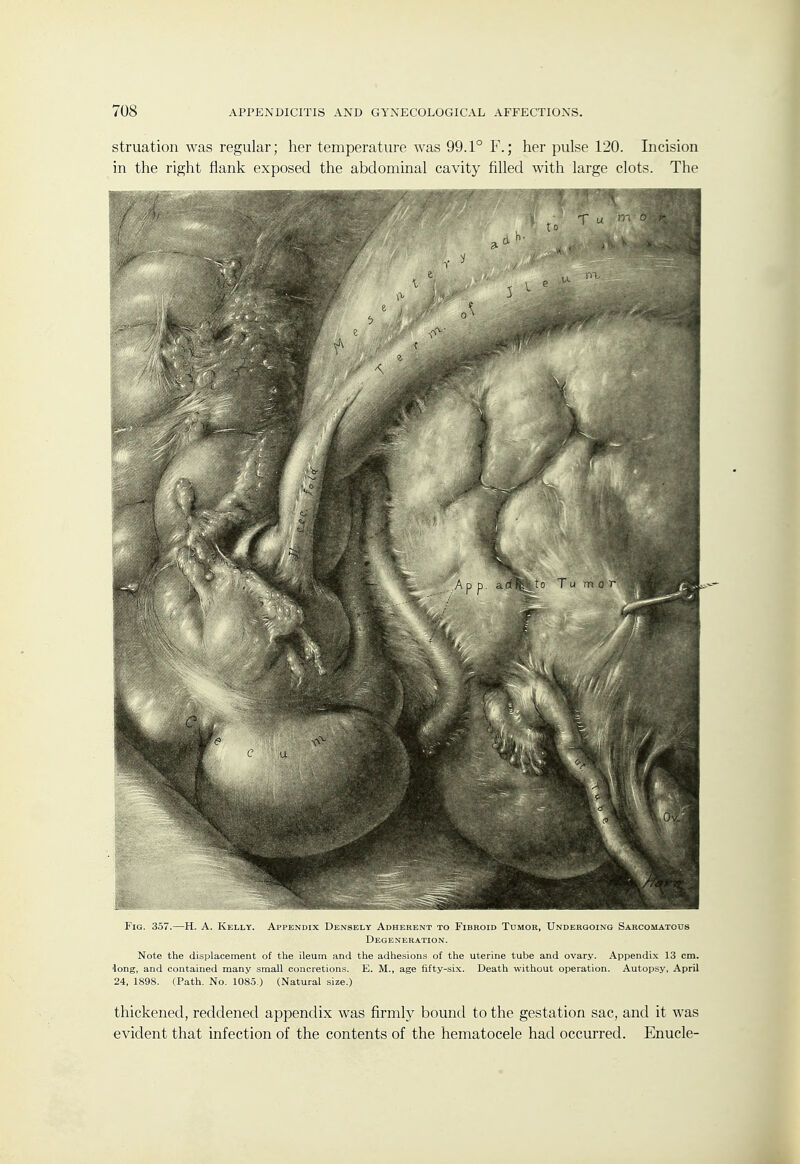 struation was regular; her temperature was 99.1° F.; her pulse 120. Incision in the right flank exposed the abdominal cavity filled with large clots. The Fig. 357.—H. A. Kelly. Appendix Densely Adherent to Fibroid Tumor, Undergoing Sarcomatods Degeneration. Note the displacement of the ileum and the adhesions of the uterine tube and ovary. Appendix 13 cm. dong, and contained many small concretions. E. M., age fifty-six. Death without operation. Autopsy, April 24, 1898. (Path. No. 1085.) (Natural size.) thickened, reddened appendix was firmly bound to the gestation sac, and it was evident that infection of the contents of the hematocele had occurred. Enucle-