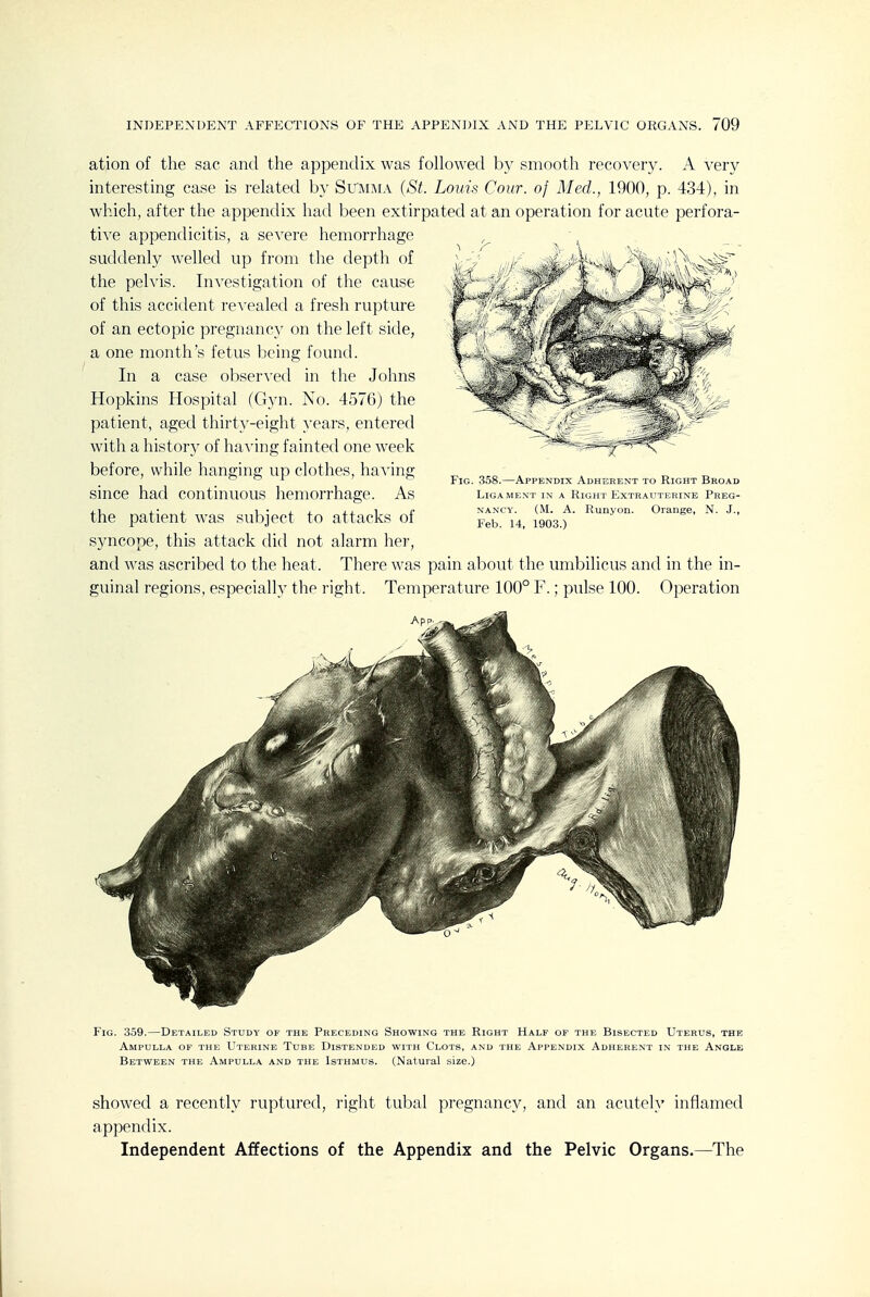 ation of the sac and the appendix was followed by smooth recovery. A very interesting case is related by Summa (St. Louis Conr. of Med., 1900, p. 434), in which, after the appendix had been extirpated at an operation for acute perfora- tive appendicitis, a severe hemorrhage suddenly welled up from the depth of the pelvis. Investigation of the cause of this accident revealed a fresh rupture of an ectopic pregnancy on the left side, a one month's fetus being found. In a case observed in the Johns Hopkins Hospital (Gyn. No. 4576) the patient, aged thirty-eight years, entered with a history of having fainted one week before, while hanging up clothes, having since had continuous hemorrhage. As the patient was subject to attacks of syncope, this attack did not alarm her, and was ascribed to the heat. There was pain about the umbilicus and in the in- guinal regions, especially the right. Temperature 100° F.; pulse 100. Operation Fig. 358.—Appendix Adherent to Right Broad Ligament in a Kight Extrautekine Preg- nancy. (M. A. Runyon. Orange, N. J., Feb. 14, 1903.) Fig. 359.—Detailed Study of the Preceding Showing the Right Half of the Bisected Uterus, the Ampulla of the Uterine Tube Distended with Clots, and the Appendix Adherent in the Angle Between the Ampulla and the Isthmus. (Natural size.) showed a recently ruptured, right tubal pregnancy, and an acutely inflamed appendix. Independent Affections of the Appendix and the Pelvic Organs.—The