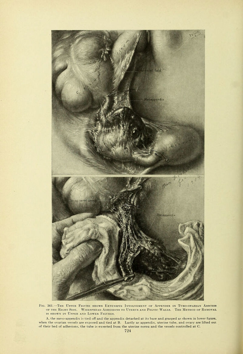 Fig. 361.—The Upper Figure shows Extensive Involve.ment df Appendix in Tubo-ovarian Abscess OF THE Right Side. Widespread Adhesions to Uterus and Pelvic Walls. The Method of Removal IS SHOWN IN Upper and Lower Figures. A, the meso-appendix is tied off and the appendix detached at its base and grasped as shown in lower figure, when the ovarian vessels are exposed and tied at B. Lastly as appendix, uterine tube, and ovary are lifted out of their bed of adhesions, the tube is exsected from the uterine cornu and the vessels controlled at C.