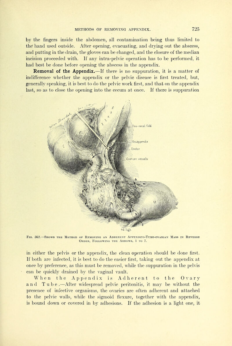 by the fingers inside the abdomen, all contamination being thus limited to the^ hand used outside. After opening, evacuating, and drying out the abscess, and putting in the drain, the gloves can be changed, and the closure of the median incision proceeded with. If any intra-pelvic operation has to be performed, it had best be done before opening the abscess in the appendix. Removal of the Appendix.—If there is no suppuration, it is a matter of indifference whether the appendix or the pelvic disease is first treated, but, generally speaking, it is best to do the pelvic work first, and that on the appendix last, so as to close the opening into the cecum at once. If there is suppuration Fig. 362.—Shows the Method of Removing an Adherent Appendico-Tubo-ovarian Mass in Reverse Order, Following the Arrows, 1 to 7. in either the pelvis or the appendix, the clean operation should be done first. If both are infected, it is best to do the easier first, taking out the appendix at once by preference, as this must be removed, while the suppuration in the pelvis can be quickly drained by the vaginal vault. When the Appendix is Adherent to the Ovary and T u b e .—After widespread pelvic peritonitis, it may be without the presence of infective organisms, the ovaries are often adherent and attached to the pelvic walls, while the sigmoid flexure, together with the appendix, is bound down or covered in by adhesions. If the adhesion is a light one, it