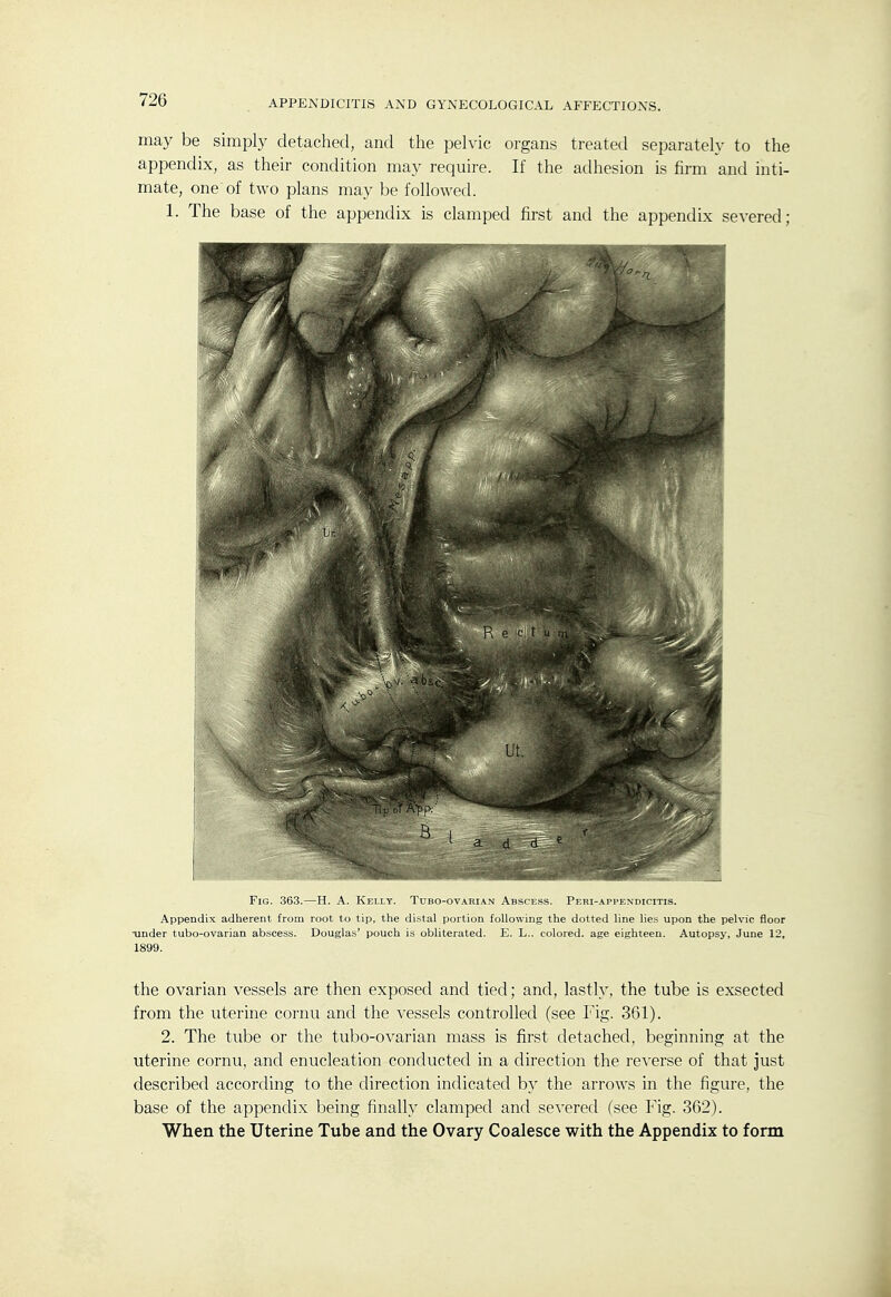 may be simply detached, and the pelvic organs treated separately to the appendix, as their condition may require. If the adhesion is firm and inti- mate, one of two plans may be followed. 1. The base of the appendix is clamped first and the appendix severed; Fig. 363.—H. A. Kelly. Tubo-ovarian Abscess. Peri-appendicitis. Appendix adherent from root to tip, the distal portion following the dotted line lies upon the pelvic floor Tinder tubo-ovarian abscess. Douglas' pouch is obliterated. E. L.. colored, age eighteen. Autopsj', June 12, 1899. the ovarian vessels are then exposed and tied; and, lastly, the tube is exsected from the uterine cornu and the vessels controlled (see Fig. 361). 2. The tube or the tubo-ovarian mass is first detached, beginning at the uterine cornu, and enucleation conducted in a direction the re^-erse of that just described according to the direction indicated by the arrows in the figure, the base of the appendix being finally clamped and severed (see Fig. 362). When the Uterine Tube and the Ovary Coalesce with the Appendix to form