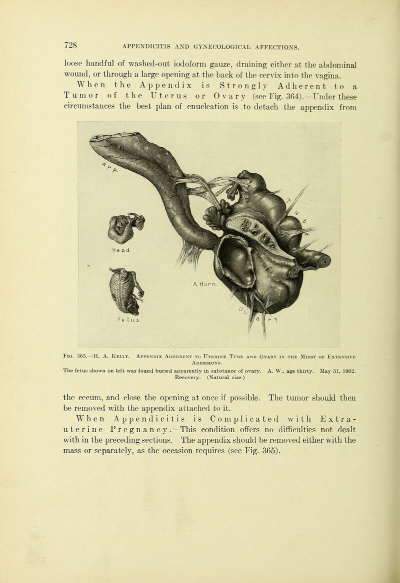 loose handful of washed-out iodoform gauze, draining either at the abdominal wound, or through a large opening at the back of the cervix into the vagina. When the Appendix is Strongly Adherent to a Tumor of the Uterus or Ovary (see Fig. 364).—Under these circumstances the best plan of enucleation is to detach the appentlix from Fig. 365.—H. A. Kelly. Appendix Adherent to Uterine Tube and Ovary in the JIidst of Extensive- Adhesions. The fetus shown on left was found buried apparently in substance of ovary. A. W., age thirty. May 31, 1902. Recovery. (Natural size.) the cecum, and close the opening at once if possible. The tumor should then be removed with the appendix attached to it. When Appendicitis is Complicated with Extra- uterine Pregnancy .—This condition offers no difficulties not dealt with in the preceding sections. The appendix should be removed either with the mass or separately, as the occasion requires (see Fig. 365).