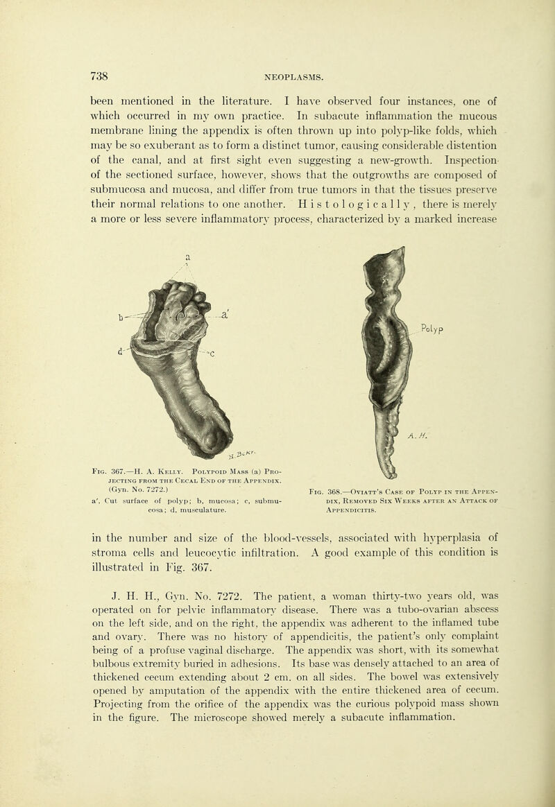 been mentioned in the literature. I have observed four instances, one of which occurred in my own practice. In subacute inflammation the mucous membrane lining the appendix is often thrown up into polyp-like folds, which may be so exuberant as to form a distinct tumor, causing considerable distention of the canal, and at first sight even suggestmg a new-growth. Inspection of the sectioned surface, however, shows that the outgrowths are composed of submucosa and mucosa, and differ from true tumors in that the tissues preserve their normal relations to one another. Histologicallj', there is merely a more or less severe inflammatory process, characterized by a marked increase (Gyn. No. 7272.) 353—Oviatt's Case op Poltp in the Appex- a', Cut surface of polyp; b, mucosa; c, submu- dix, Removed Six Weeks after an Attack of cosa; d, musculature. Appendicitis. in the number and size of the blood-vessels, associated with hyperplasia of stroma cells and leucocytic infiltration. A good example of this condition is illustrated in Fig. 367. J. H. H., Gyn. No. 7272. The patient, a woman thirty-two years old, was operated on for pelvic inflammatory disease. There was a tubo-ovarian abscess on the left side, and on the right, the appendix was adherent to the inflamed tube and ovary. There was no history of appendicitis, the patient's only complaint being of a profuse vaginal discharge. The appendix was short, ^xith. its somewhat bulbous extremity buried in adhesions. Its base was densely attached to an area of thickened cecum extending about 2 cm. on all sides. The bowel was extensively opened by amputation of the appendix with the entire thickened area of cecum. Projecting from the orifice of the appendix was the curious polypoid mass shown in the figure. The microscope showed merely a subacute inflammation.