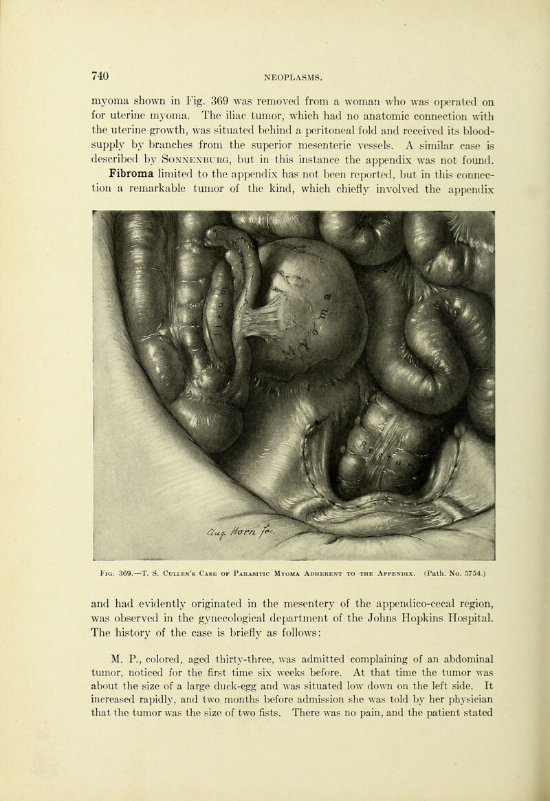 myoma shown in Fig. 369 was removed from a woman who was operated on for uterine myoma. The iliac tumor, which had no anatomic connection with the! uterine growth, was situated behind a peritoneal fold and received its blood- supply by branches from the superior mesenteric vessels. A similar case is described by Sonnenburg, but in this instance the appendix was not found. Fibroma limited to the appendix has not been reported, but in this connec- tion a remarkable tumor of the kind, which chiefly involved the appendix Fig. 369.—T. S. Cullen's Case of Pahasitic Myoma Adherent to the Appendix. (Path. No. 5754.) and had evidently originated in the mesenter)^ of the append ico-cecal region, was observed in the gynecological department of the Johns Hopkins Hospital. The history of the case is briefly as follows: M. P., colored, aged thirty-three, was admitted complaining of an abdominal tumor, noticed for the first time six weeks before. At that time the tumor was about the size of a large duck-egg and was situated low down on the left side. It increased rapidly, and two months before admission she was told by her physician that the tumor was the size of two fists. There was no pain, and the patient stated