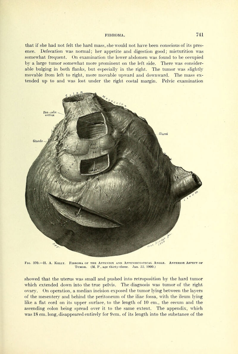 that if she had not felt the hard mass, she would not have been conscious of its pres- ence. Defecation was normal; her appetite and digestion good; micturition was somewhat frequent. On examination the lower abdomen was found to be occupied by a large tumor somewhat more prominent on the left side. There was consider- able bulging in both flanks, but especially in the right. The tumor was slightly movable from left to right, more movable upward and downward. The mass ex- tended up to and was lost under the right costal margin. Pelvic examination Fig. 370.—H. A. Kelly. Fibroma of the Appendix and Appendico-cecal Angle. Anterior Aspect of Tumor. (M. P., age thirty-three. Jan. 22, 1900.) showed that the uterus was small and pushed into retroposition by the hard tumor which extended down into the true pelvis. The diagnosis was tumor of the right ovary. On operation, a median incision exposed the tumor lying between the layers of the mesentery and behind the peritoneum of the iliac fossa, with the ileum lying like a flat cord on its upper surface, to the length of 10 cm., the cecum and the ascending colon being spread over it to the same extent. The appendix, which was 18 cm. long, disappeared entirely for 9 cm. of its length into the substance of the