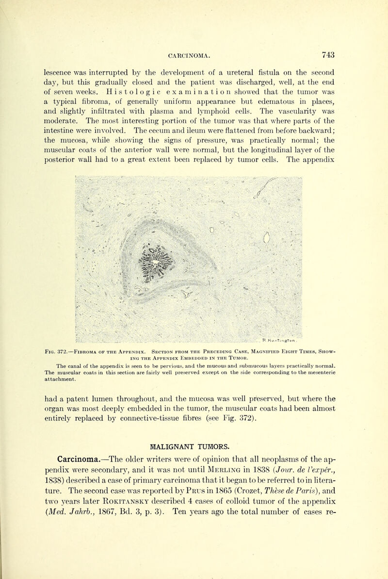 lescence was interrupted by the development of a ureteral fistula on the second day, but this gradually closed and the patient was discharged, well, at the end of seven weeks. Histologic examination showed that the tumor was a typical fibroma, of generally uniform appearance but edematous in places, and slightly infiltrated with plasma and lymphoid cells. The vascularity was moderate. The most interesting portion of the tumor was that where parts of the intestine were involved. The cecum and ileum were flattened from before backward; the mucosa, while showing the signs of pressure, was practically normal; the muscular coats of the anterior wall were normal, but the longitudinal layer of the posterior wall had to a great extent been replaced by tumor cells. The appendix : ■ ' . . , H Hu,.iT,naton. Fig. 372.—Fibroma of the Appendix. Section from the Preceding Case, Magnified Eight Times, Show- ing THE Appendix Embedded in the Tumor. The canal of the appendix is seen to be pervious, and the mucous and submucous layers practically normal. The muscular coats in this section are fairly well preserved except on the side corresponding to the mesenteric attachment. had a patent lumen throughout, and the mucosa was well preserved, but where the organ was most deepl}^ embedded in the tumor, the muscular coats had been almost entirely replaced by connective-tissue fibres (see Fig. 372). MALIGNANT TUMORS. Carcinoma.—^The older writers were of opinion that all neoplasms of the ap- pendix were secondary, and it was not until Merling in 1838 (Jour, de Vexper., 1838) described a case of primar}^ carcinoma that it began to be referred to in litera- ture. The second case was reported by Prus in 1865 (Crozet, These de Paris), and two years later Rokitansky described 4 cases of colloid tumor of the appendix {Med. Jahrb., 1867, Bd. 3, p. 3). Ten years ago the total number of cases re-