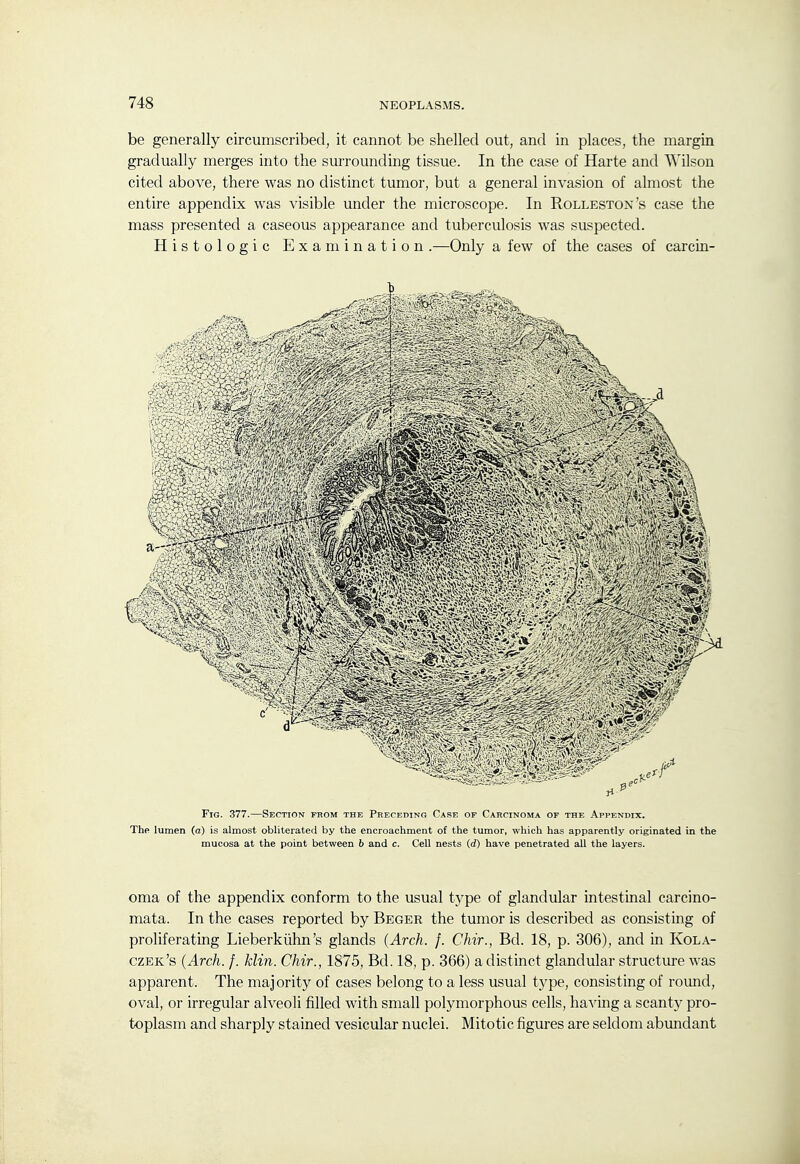 be generally circumscribed, it cannot be shelled out, and in places, the margin gradually merges into the surrounding tissue. In the case of Harte and T\'ilson cited above, there was no distinct tumor, but a general invasion of almost the entire appendix was visible under the microscope. In Rolleston's case the mass presented a caseous appearance and tuberculosis was suspected. Histologic Examination .—Only a few of the cases of carcin- FiG. 377.—Section from the Preceding Case op Carcinoma op the Appendix. The lumen (a) is almost obliterated by the encroachment of the tumor, which has apparently originated in the mucosa at the point between 6 and c. Cell nests (d) have penetrated all the layers. oma of the appendix conform to the usual type of glandular intestinal carcino- mata. In the cases reported by Beger the tumor is described as consisting of proliferating Lieberkiihn's glands {Arch. f. Chir., Bd. 18, p. 306), and in Kola- czek's (Arch. f. klin. Chir., 1875, Bd. 18, p. 366) a distinct glandular structure was apparent. The majority of cases belong to a less usual type, consisting of round, oval, or irregular alveoli filled with small polymorphous cells, having a scanty pro- toplasm and sharply stained vesicular nuclei. Mitotic figures are seldom abimdant