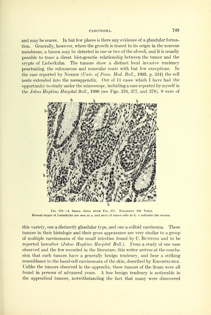 and may be scarce. In but few places is there any evidence of a glandular forma- tion. Generally, however, where the growth is traced to its origin in the nmcous membrane, a lumen may be detected in one or two of the alveoli, and it is usually possible to trace a direct histogenetic relationship between the tumor and the crypts of Lieberkiihn. The tumors show a distinct local invasive tendency penetrating the submucous and muscular coats with but few exceptions. In the case reported by Norms {Univ. of Penn. Med. Bull., 1903, p. 334) the cell nests extended into the mesappendix. Out of 11 cases which I have had the opportunity to study under the microscope, including a case reported by myself in the Johns Hopkins Hospital Bull., 1900 (see Figs. 376, 377, and 378), 9 were of b Fig. 378.—A Small Area from Fig. 377. Enlarged 350 Times. Normal crypts of Lieberkiihn are seen at a, and nests of tumor cells at b; c indicates the stroma. this variety, one a distinctly glandular type, and one a colloid carcinoma. These tumors in their histologic and their gross appearance are very similar to a group of multiple carcinomata of the small intestine found by C. Bunting and to be reported hereafter (Johns Hopkins Hospital Bull.). From a study of one case observed and the few recorded in the literature, this writer arrives at the conclu- sion that such tumors have a generally benign tendency, and bear a striking, resemblance to the basal-cell carcinomata of the skin, described by Krompecher. Unlike the tumors observed in the appendix, these tumors of the ileum were all found in persons of advanced years. A less benign tendency is noticeable in the appendical tumors, notwithstanding the fact that many were discovered