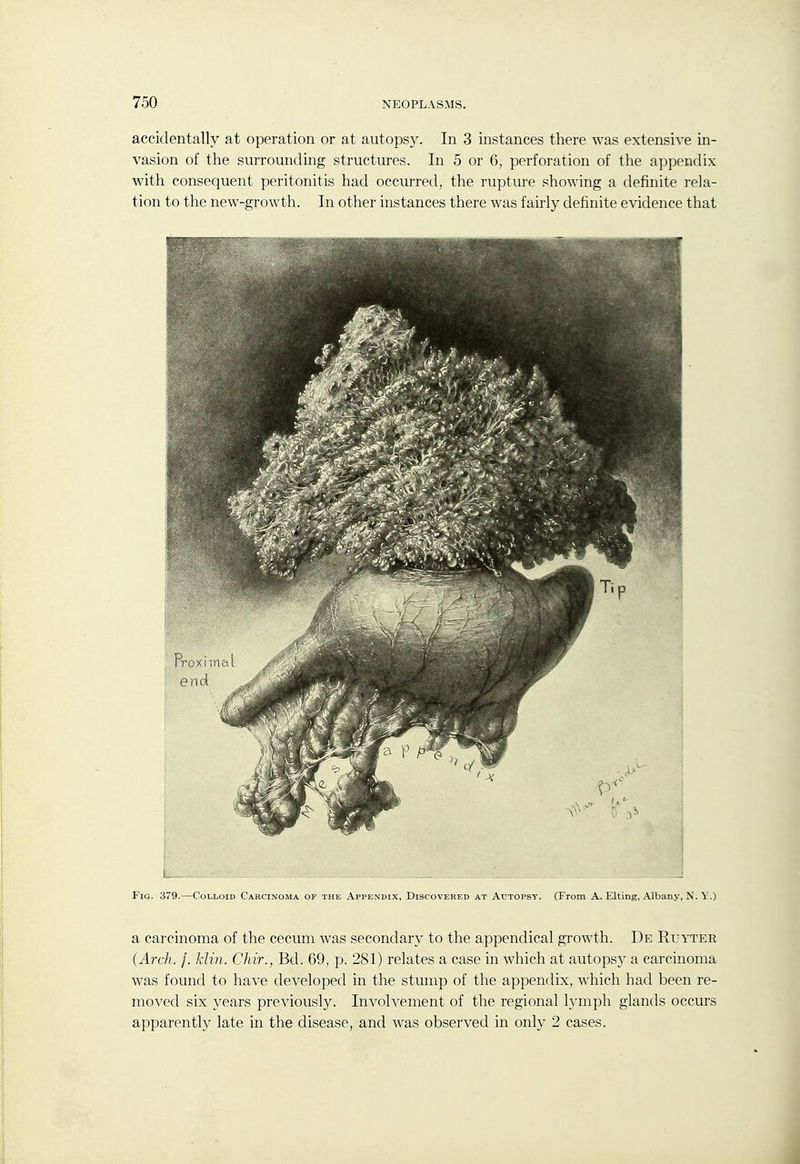 accidentally at operation or at autopsy. In 3 instances there was extensive in- vasion of the surrounding structures. In 5 or 6, perforation of the appendix with consequent peritonitis had occurred, the rupture showing a definite rela- tion to the new-growth. In other instances there was fairly definite evidence that Fig. 379.—Colloid Carcinoma of the Appendix, Discovered at Autopsy. (From A. Elting, Albany, N. Y.) a carcinoma of the cecum was secondary to the appendical growth. De Ruyter (Arch. /. klin. Chir., Bd. 69, p. 281) relates a case in which at autopsy a carcinoma was found to have developed in the stump of the appendix, which had been re- moved six years previously. Involvement of the regional lymph glands occurs apparently late in the disease, and was observed in only 2 cases.