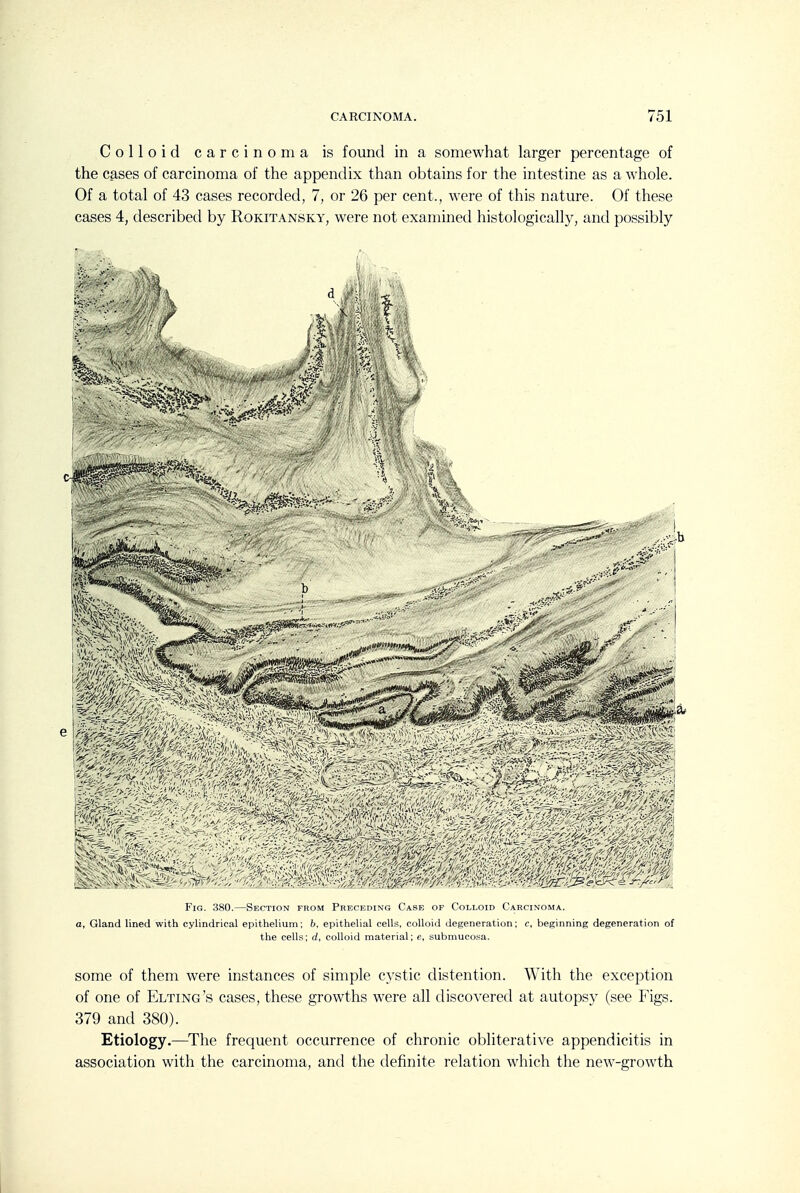 Colloid carcinoma is found in a somewhat larger percentage of the cases of carcinoma of the appendix than obtains for the intestine as a whole. Of a total of 43 cases recorded, 7, or 26 per cent., were of this nature. Of these cases 4, described by Rokitansky, were not examined histologically, and possibly Fig. 380.—Section from Preceding Case of Colloid Carcinoma. a. Gland lined with cylindrical epithelium; 6, epithelial cells, colloid degeneration; c, beginning degeneration of the cells; d, colloid material; e, submucosa. some of them were instances of simple cystic distention. With the exception of one of Elting's cases, these growths were all discovered at autopsy (see Figs. 379 and 380). Etiology.—^The frequent occurrence of chronic obliterative appendicitis in association with the carcinoma, and the definite relation which the new-growth