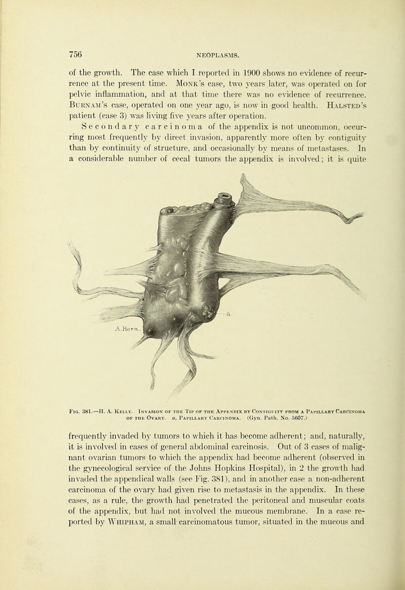 of the growth. The case which I reported in 1900 shows no evidence of recur- rence at the present time. Monk's case, two years later, was operated on for pelvic inflammation, and at that time there was no evidence of recurrence. Burn AM's case, operated on one year ago, is now in good health. Halsted's patient (case 3) was living five years after operation. Secondary carcinoma of the appendix is not uncommon, occur- ring most frequently by direct invasion, apparently more often by contiguity than by continuity of structure, and occasionally by means of metastases. In a considerable number of cecal tumors the appendix is involved; it is quite Fig. 381.—H. A. Kelly. Invasion of the Tip of the Appendix by Contiguity from a Papillary Carcinoma OF THE Ovary, a. Papillary Carcinoma. (Gyn. Path. No. 5607.) frequently invaded by tumors to which it has become adherent; and, naturally, it is involved in cases of general abdominal carcinosis. Out of 3 cases of malig- nant ovarian tumors to which the appendix had become adherent (observed in the gynecological service of the Johns Hopkins Hospital), in 2 the growth had invaded the appendical walls (see Fig. 381), and in another case a non-adherent carcinoma of the ovary had given rise to metastasis in the appendix. In these rule, the growth had penetrated the peritoneal and muscular coats of the appendix, but had not involved the mucous membrane. In a case re- ported by Whipham, a small carcinomatous tumor, situated in the mucous and