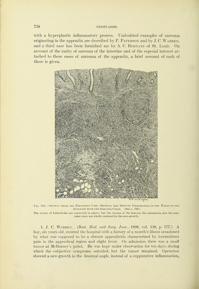 with a hyperplastic inflammatory process. Undoubted examples of sarcoma originating in the appendix are described by P. Paterson and b}- J. C. A\'arrex, and a third case has been furnished me by A. C. Berxays of St. Louis. On account of the rarity of sarcoma of the intestine and of the especial interest at- tached to these cases of sarcoma of the appendix, a brief account of each of these is given. TiG. 383.—Section from the Preceding Case, Showing the Diffuse Infiltration of the Walls of the Appendix with the Saecoma Cells. (See p. 760.) The crypts of Lieberkiihn are preserved in places, but the stroma of the mucosa, the submucosa, ana the mus- cular coats are wholly replaced by the new-growth. 1. J. C. Warren. {Bost. Med. and Siirg. Jour., 1S9S, vol. 138, p. 177.) A boy, six 3^ears old, entered the hospital with a history of a month's illness occasioned by what was supposed to be a chronic appendicitis characterized by intermittent pain in the appendical region and slight fever. On admission there was a small tumor at McBurney's point. He was kept under observation for ten days, during which the subjective symj^toms subsided, but the tumor remained. Operation showed a new-growth in the ileocecal angle, instead of a suppurative inflammation,