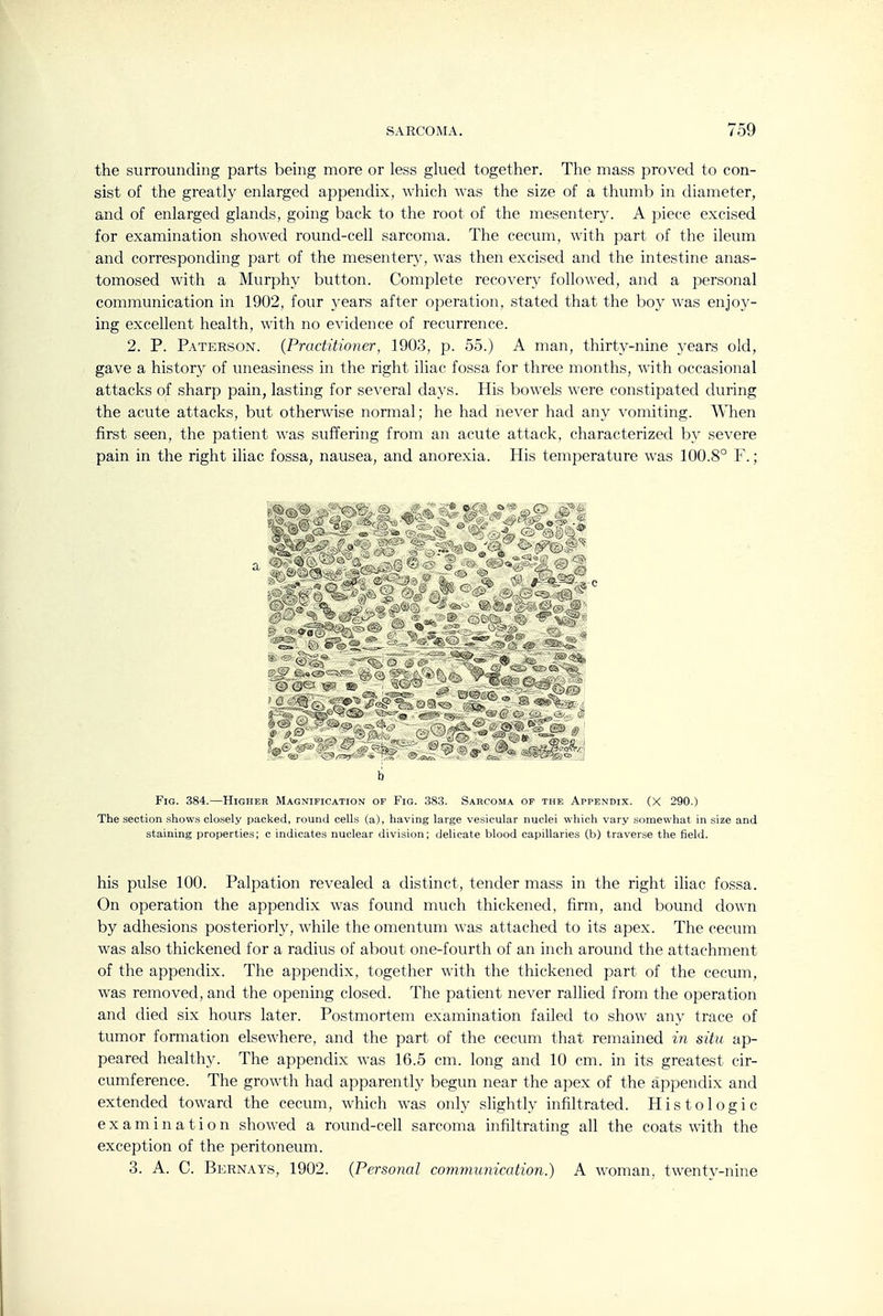 the surrounding parts being more or less glued together. The mass proved to con- sist of the greatly enlarged appendix, which was the size of a thumb in diameter, and of enlarged glands, going back to the root of the mesentery. A piece excised for examination showed round-cell sarcoma. The cecum, with part of the ileum and corresponding part of the mesentery, was then excised and the intestine anas- tomosed with a Murphy button. Complete recovery followed, and a personal communication in 1902, four years after operation, stated that the boy was enjoy- ing excellent health, with no evidence of recurrence. 2. P. Paterson. {Practitioner, 1903, p. 55.) A man, thirty-nine years old, gave a history of uneasiness in the right iliac fossa for three months, with occasional attacks of sharp pain, lasting for several daj's. His bowels were constipated during the acute attacks, but otherwise normal; he had never had any vomiting, ^^^len first seen, the patient was suffering from an acute attack, characterized by severe pain in the right iliac fossa, nausea, and anorexia. His temperature was 100.8° F.; b Fig. 384.—Higher Magnification of Fig. 383. Sarcoma of the Appendix. (X 290.) The section shows closely packed, round cells (a), having large vesicular nuclei which vary somewhat in size and staining properties; c indicates nuclear division; delicate blood capillaries (b) traverse the field. his pulse 100. Palpation revealed a distinct, tender mass in the right iliac fossa. On operation the appendix was found much thickened, firm, and bound down by adhesions posteriorly, while the omentum was attached to its apex. The cecum was also thickened for a radius of about one-fourth of an inch around the attachment of the appendix. The appendix, together with the thickened part of the cecum, was removed, and the opening closed. The patient never rallied from the operation and died six hours later. Postmortem examination failed to show any trace of tumor formation elsewhere, and the part of the cecum that remained in situ ap- peared healthy. The appendix was 16.5 cm. long and 10 cm. in its greatest cir- cumference. The growth had apparently begun near the apex of the appendix and extended toward the cecum, which was only slightly infiltrated. Histologic examination showed a round-cell sarcoma infiltrating all the coats with the exception of the peritoneum. 3. A. C. Bernays, 1902. (Personal communication.) A woman, twentv-nine
