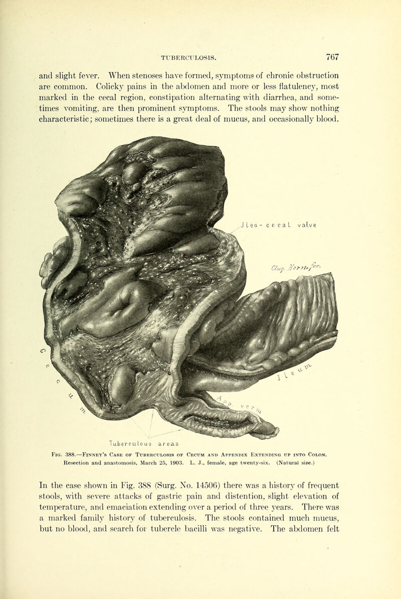 and sliglit fever. When stenoses have formed, symptoms of chronic obstruction are common. Cohcky pains in the abdomen and more or less flatulency, most marked in the cecal region, constipation alternating with diarrhea, and some- times vomiting, are then prominent symptoms. The stools may show nothing characteristic; sometimes there is a great deal of mucus, and occasionally blood. Tuberculous areas Fig. 388.—Finney's Case of Tuberculosis of Cecum and Appendix Extending up into Colon. Resection and anastomosis, March 25, 1903. L. ,T., female, age twenty-six. (Natural size.) In the case shown in Fig. 388 (Surg. No. 14506) there was a history of frequent stools, with severe attacks of gastric pain and distention, slight elevation of temperature, and emaciation extending over a period of three years. There was a marked family history of tuberculosis. The stools contained much mucus, but no blood, and search for tubercle bacilli was negative. The abdomen felt