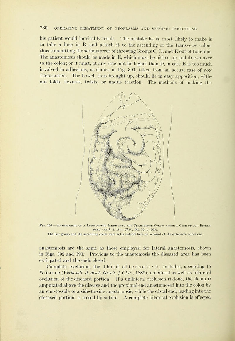 his patient would inevitably result. The mistake he is most likely to make is to take a loop in B, and attach it to the ascending or the transverse colon, thus committing the serious error of throwing Groups C, D, and E out of function. The anastomosis should be made in E, which must be picked up and drawn o^-er to the colon; or it must, at any rate, not be higher than D, in case E is too much involved in adhesions, as shown in Fig. 391, taken from an actual case of von EisELSBERG. The bowel, thus brought up, should lie in easy apposition, with- out folds, flexures, twists, or undue traction. The methods of making the Fig. .391.—Anastomosis of a Loop op the Iledm into the Transverse Colon, after a Case of von Eisels- BERG (Arch. f. klin. Chir., Bd. 56, p. 303). The last group and the ascending colon were not available here on account of the extensive adhesions. anastomosis are the same as those employed for lateral anastomosis, show in Figs. 392 and 393. Previous to the anastomosis the diseased area has been extirpated and the ends closed. Complete exclusion, the third alternative, includes, according to WoLFLER (Verhandl. d. dtsch. Gesell. /. Chir., 1889), unilateral as well as bilateral occlusion of the diseased portion. If a unilateral occlusion is done, the ileum is amputated above the disease and the proximal end anastomosed into the colon by an end-to-side or a side-to-side anastomosis, while the distal end, leading into the diseased portion, is closed by suture. A complete bilateral exclusion is effected