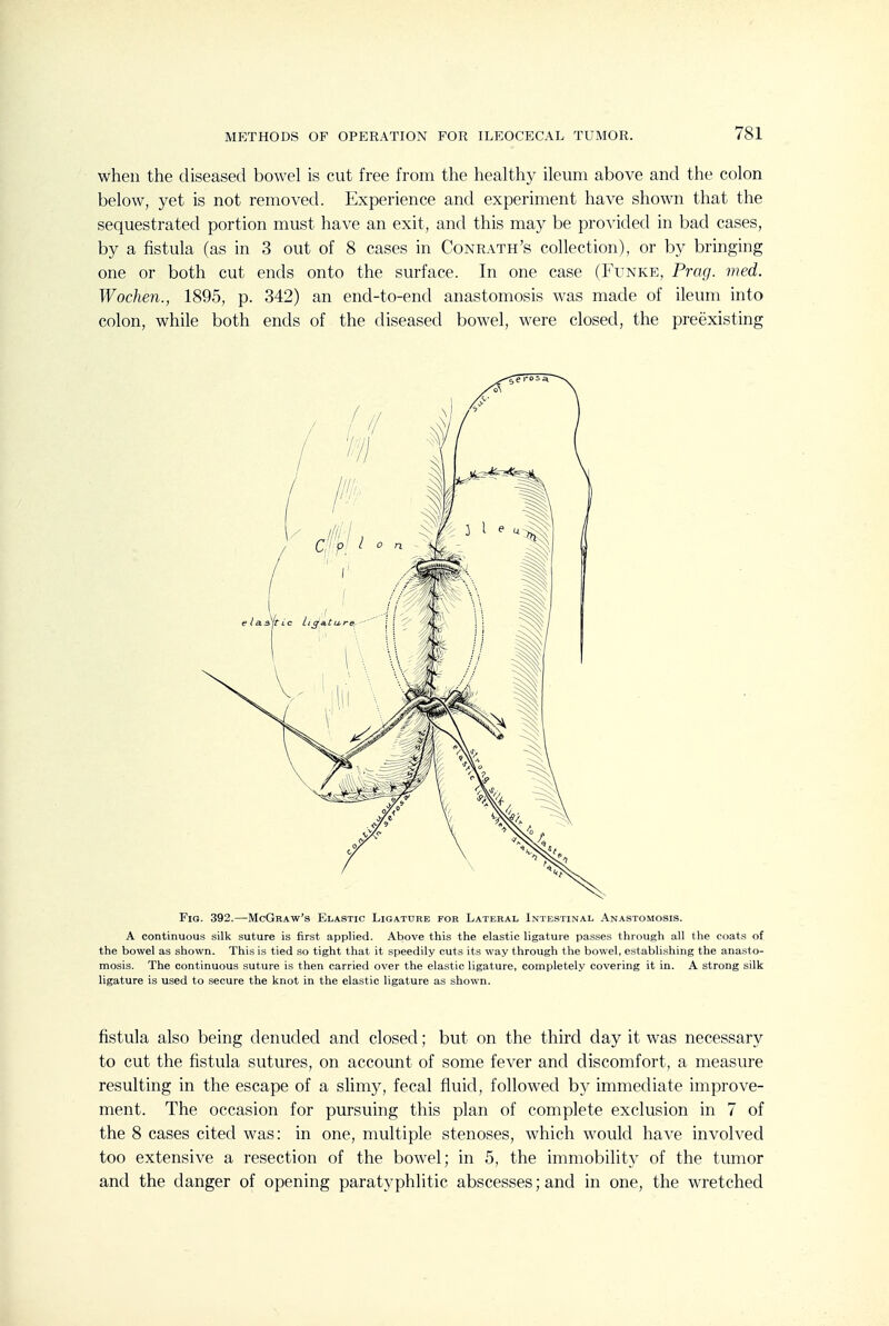 when the diseased bowel is cut free from the healthy ileum above and the colon below, yet is not removed. Experience and experiment have shown that the sequestrated portion must have an exit, and this may be provided in bad cases, by a fistula (as in 3 out of 8 cases in Conrath's collection), or by bringing one or both cut ends onto the surface. In one case (Funke, Prag. med. Wochen., 1895, p. 342) an end-to-end anastomosis was made of ileum into colon, while both ends of the diseased bowel, were closed, the preexisting Fig. 392.—McGraw's Elastic Ligature fob Lateral Intestinal Anastomosis. A continuous silk suture is first applied. Above this the elastic ligature passes through all the coats of the bowel as shown. This is tied so tight that it speedily cuts its way through the bowel, establishing the anasto- mosis. The continuous suture is then carried over the elastic ligature, completely covering it in. A strong silk ligature is used to secure the knot in the elastic ligature as shown. fistula also being denuded and closed; but on the third day it was necessary to cut the fistula sutures, on account of some fever and discomfort, a measure resulting in the escape of a slimy, fecal fluid, followed b}^ immediate improve- ment. The occasion for pursuing this plan of complete exclusion in 7 of the 8 cases cited was: in one, multiple stenoses, which would have involved too extensive a resection of the bowel; in 5, the immobility of the tumor and the danger of opening paratyphlitic abscesses; and in one, the wretched