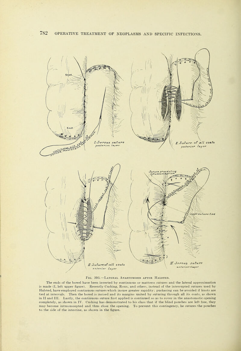 Fig. 393.—Lateral Anastomosis after Halsted. The ends of the bowel have been inverted by continuous or mattress sutures and the lateral approximation is made (I, left upper figure). Recently Gushing, Roux, and others, instead of the interrupted sutures used by Halsted, have employed continuous sutures which insure greater rapidity: puckering can be avoided if knots are tied at intervals. Then the bowel is incised and its margins united by suturing through all its coats, as shown in II and III. Lastly, the continuous suture first applied is continued so as to cover in the anastomotic opening completely, as shown in IV. Gushing has demonstrated to his class that if the blind pouches are left free, they may become intussuscepted and thus close the opening. To prevent this contingency, he sutures the pouches to the side of the intestine, as shown in the figure.