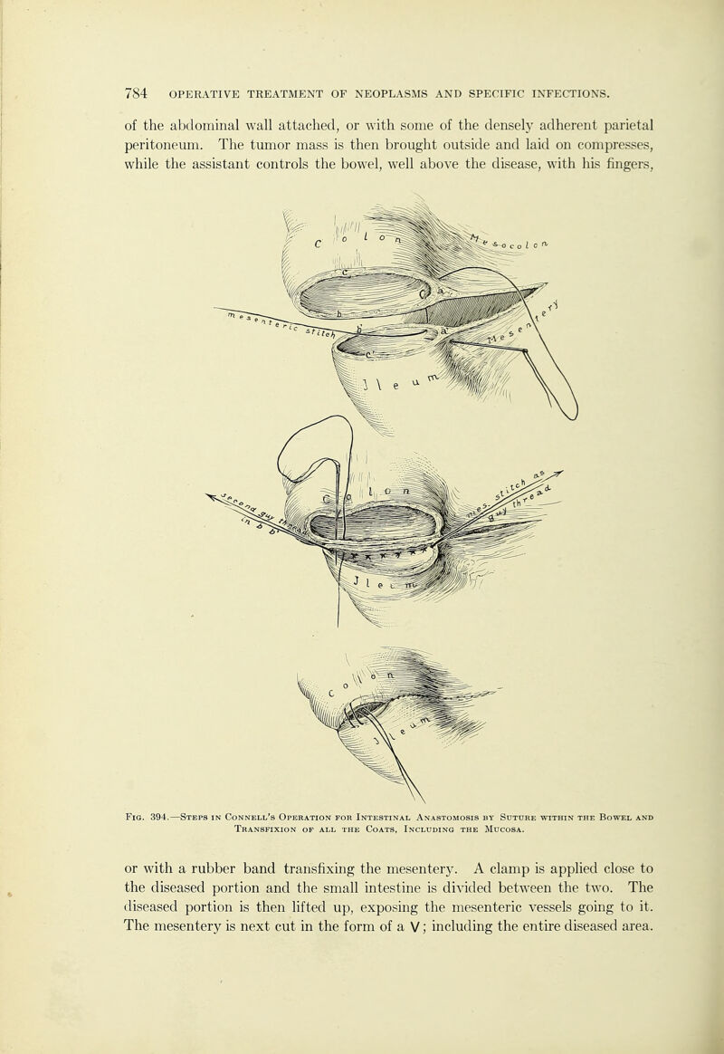 of the abdominal wall attached, or with some of the densely adherent parietal peritoneum. The tumor mass is then brought outside and laid on compresses, while the assistant controls the bowel, well above the disease, with his fingers. Fig. 394.—Steps in Connell's Operation for Intestinal Anastomosis by Sutdre within the Bowel and Transfixion of all the Coats, Including the Mucosa. or with a rubber band transfixing the mesentery. A clamp is applied close to the diseased portion and the small intestine is divided between the two. The diseased portion is then lifted up, exposing the mesenteric vessels going to it. The mesentery is next cut in the form of a V; including the entire diseased area.