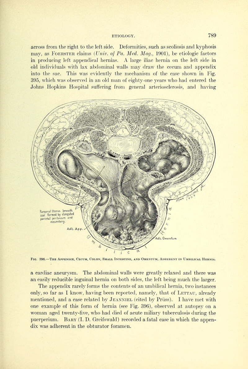 across from the right to the left side. Deformities, such as scoliosis and kyphosis may, as Foerster claims (Univ. of Pa. Med. Mag., 1901), be etiologic factors in producing left appendical hernias. A large iliac hernia on the left sitle in old individuals with lax abdominal walls may draw the cecum and appendix into the sac. This was evidently the mechanism of the case shown in Fig. 395, which was observed in an old man of eighty-one years who had entered the Johns Hopkins Hospital suffering from general arteriosclerosis, and having Fig. 396.—The Appendix, Cecum, Colon, Small Intestine, and Omentum, Adherent in Umbilical Hernia. a cardiac aneurysm. The abdominal walls were greatly relaxed and there was an easily reducible inguinal hernia on both sides, the left being much the larger. The appendix rarely forms the contents of an umbilical hernia, two instances only, so far as I know, having been reported, namely, that of Lettau, already mentioned, and a case related by Jeanniel (cited by Priiss). I have met with one example of this form of hernia (see Fig. 396), observed at autopsy on a woman aged twenty-five, who had died of acute miliary tuberculosis during the puerperium. Bary (I. D. Greifswald) recorded a fatal case in which the appen- dix was adherent in the obturator foramen.