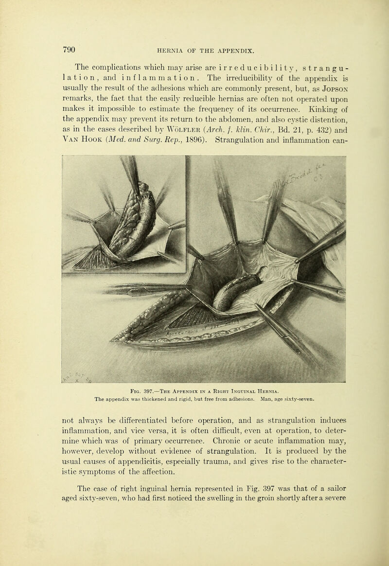 The complications which may arise are irreducibility, strangu- lation, and inflammation. The irreducibility of the appendix is usually the result of the adhesions which are commonly present, but, as Jopsox remarks, the fact that the easily reducible hernias are often not operated upon makes it impossible to estimate the frequency of its occurrence. Kinking of the appendix may prevent its return to the abdomen, and also cystic distention, as in the cases described by Wolfler (Arch. f. klin. Chir., Bd. 21, p. 432) and Van Hook (Med. and Surg. Rep., 1896). Strangulation and inflammation can- FiG. 397.—The Appendix in a Right Inguinal Hernia. The appendix was thickened and rigid, but free from adhesions. Man, age sixty-seven. not always be differentiated before operation, and as strangulation induces inflammation, and vice versa, it is often difficult, even at operation, to deter- mine which was of primary occurrence. Chronic or acute inflammation may, however, develop without evidence of strangulation. It is produced by the usual causes of appendicitis, especially trauma, and gives rise to the character- istic symptoms of the affection. The case of right inguinal hernia represented in Fig. 397 was that of a sailor aged sixty-seven, who had first noticed the swelling in the groin shortly after a severe